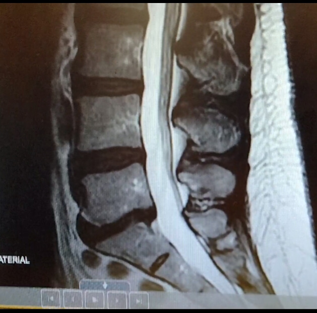 L5/S1 Retrolisthesis, the opposite of spondylolisthesis. Same fusion