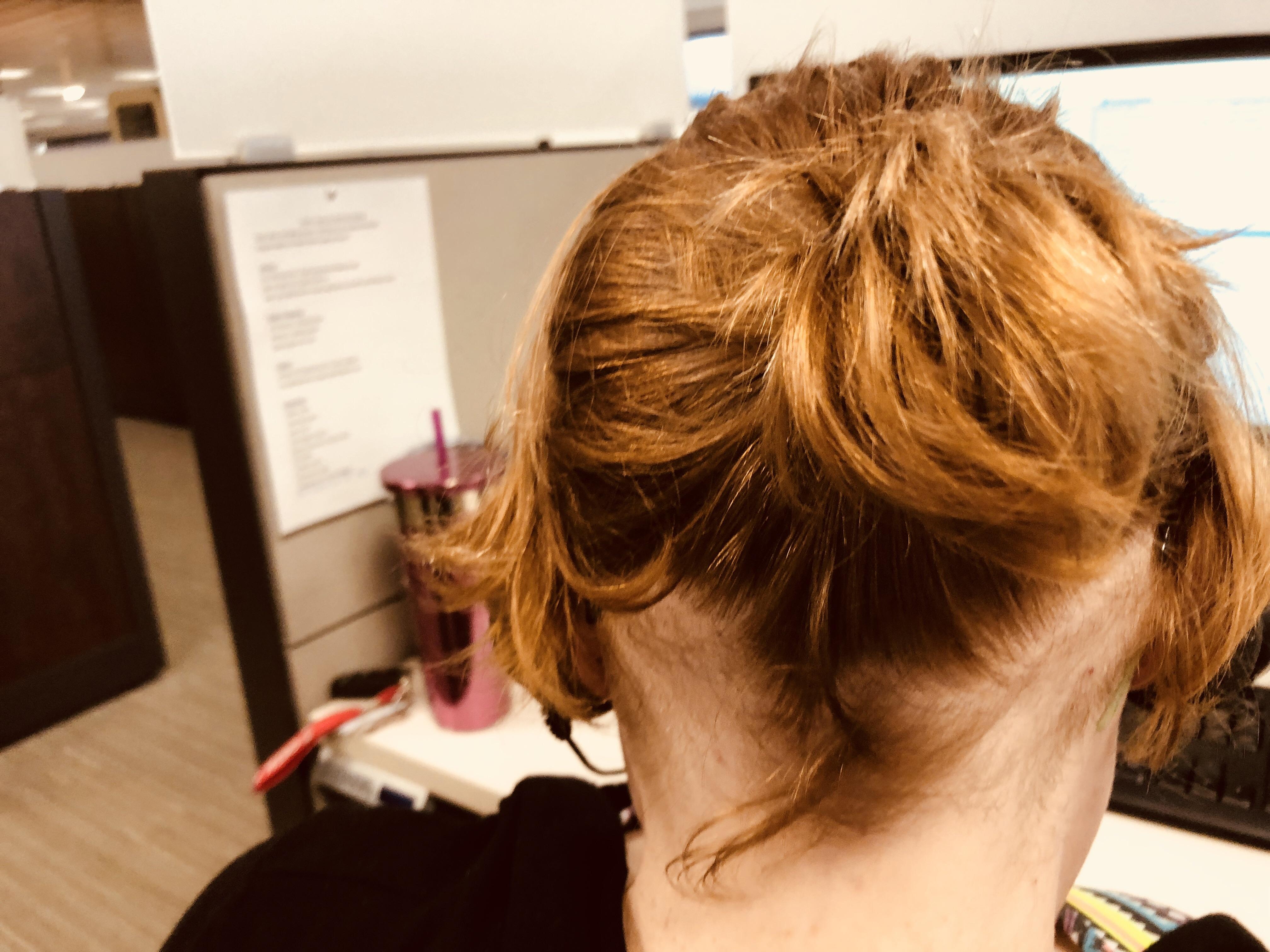 My trich/pulling spots trichotillomania