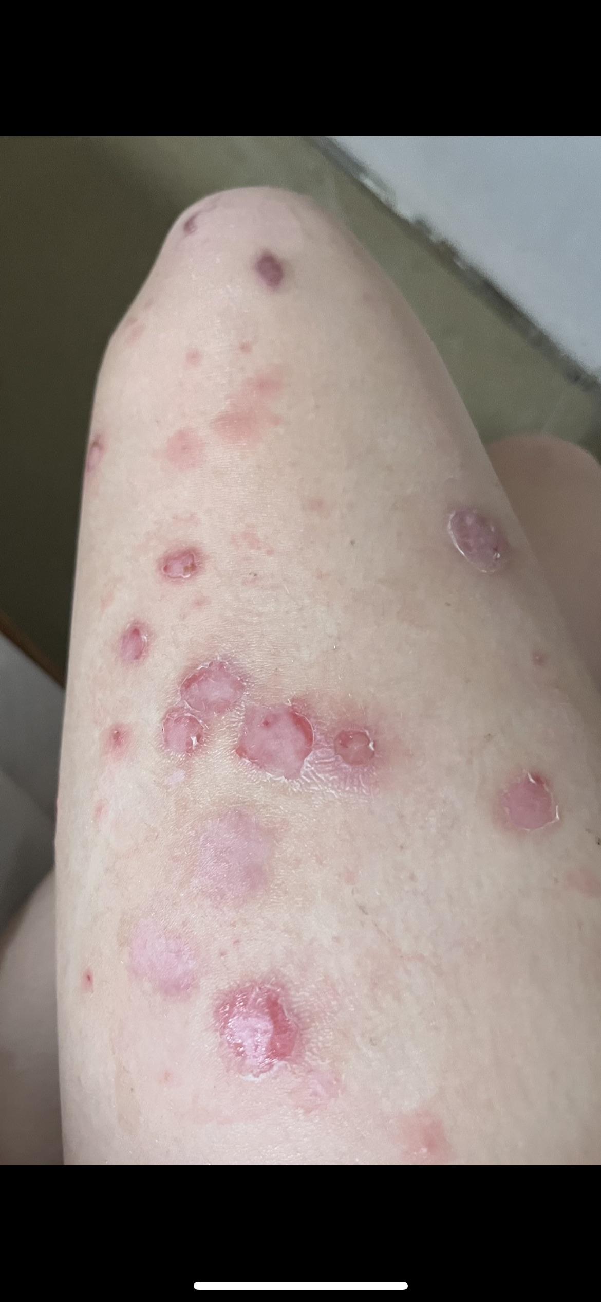 Are these school sores or something serious? r/DiagnoseMe