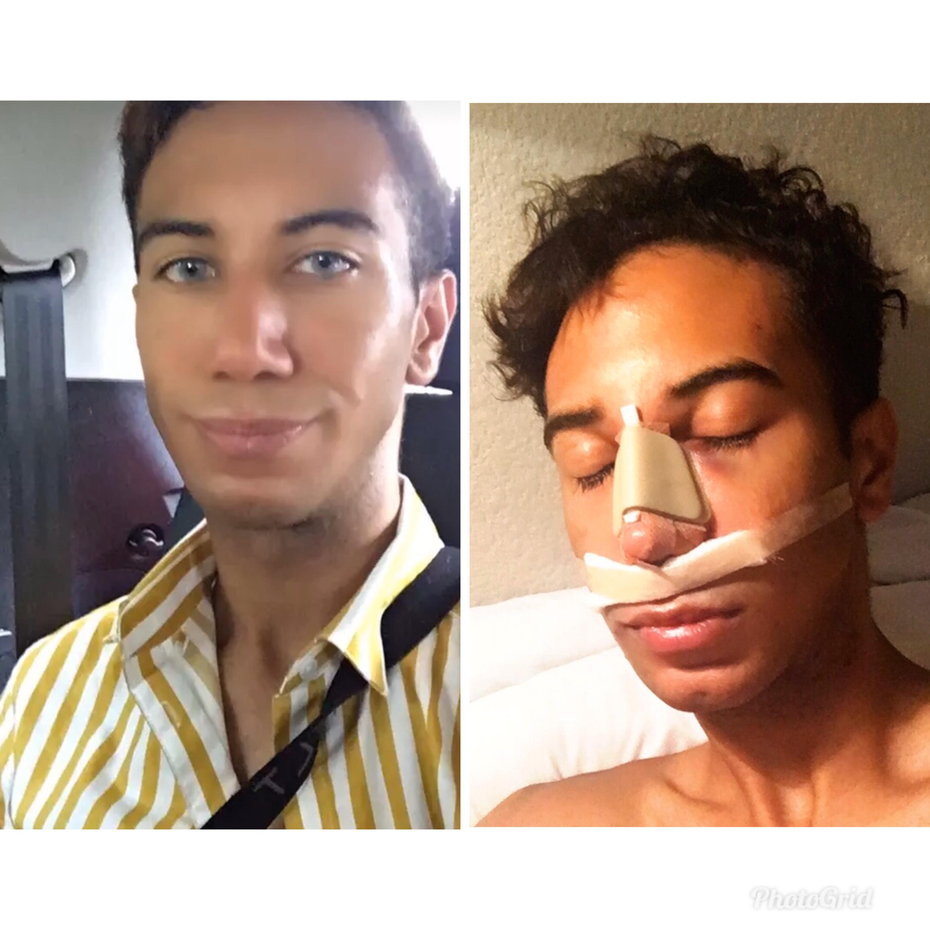 10 years of debilitating body dysmorphia centered around my nose. i