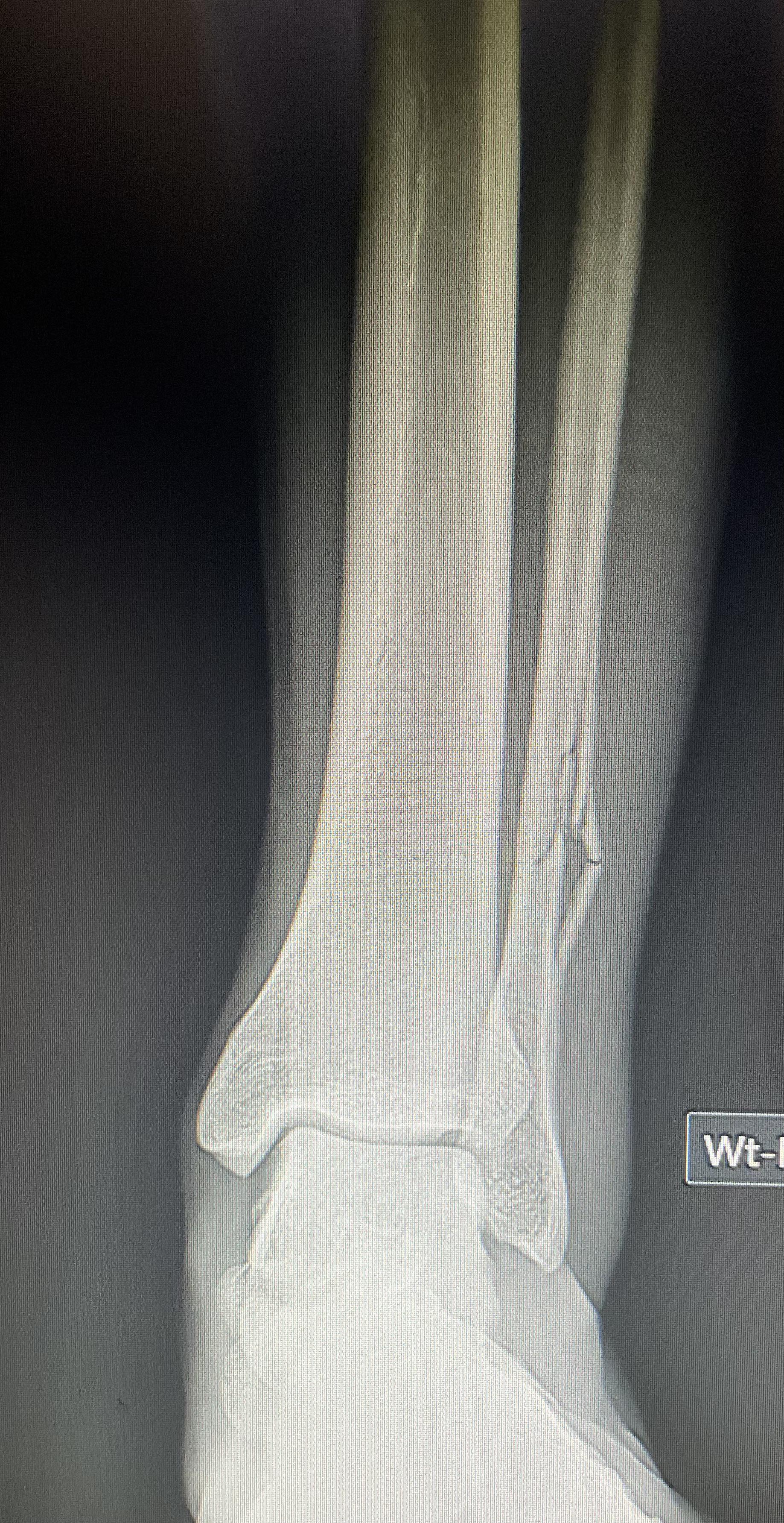 Interesting Fibula fracture in a soccer player r/Radiology
