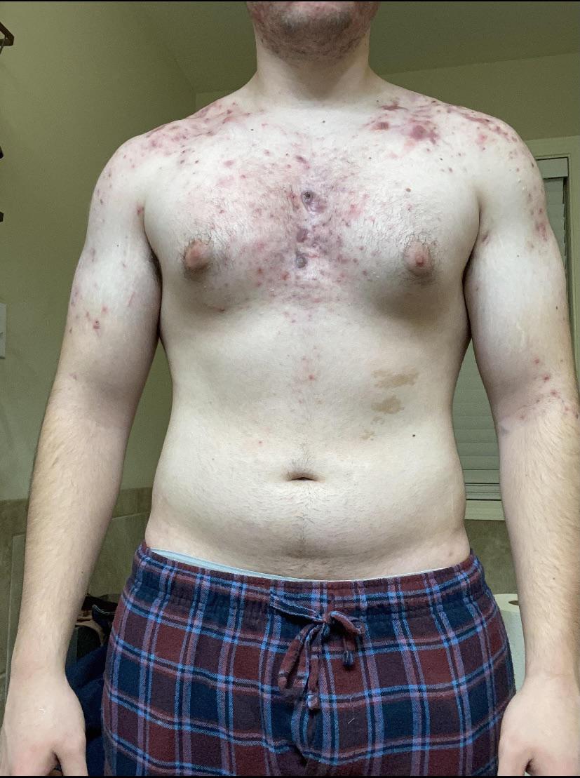 Tap water causing acne? acne