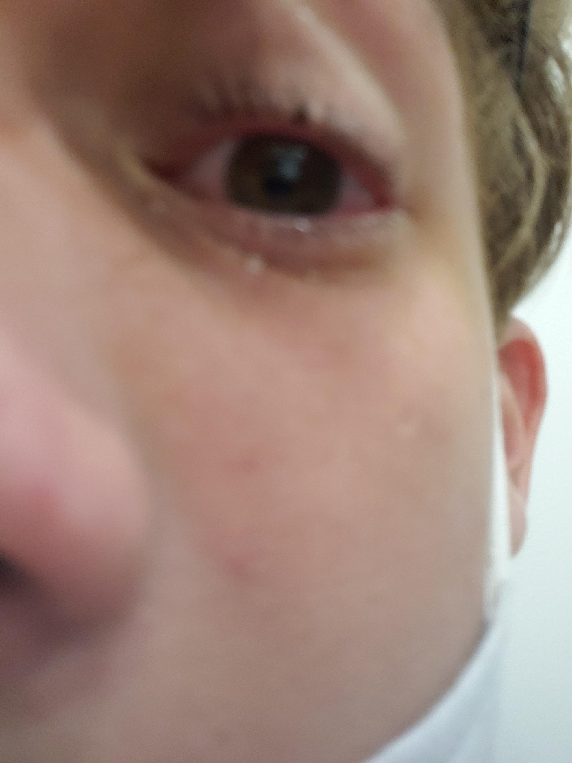 FlashBurn. Worst. Pain. Ever. Any fixes yall know of? r/Welding