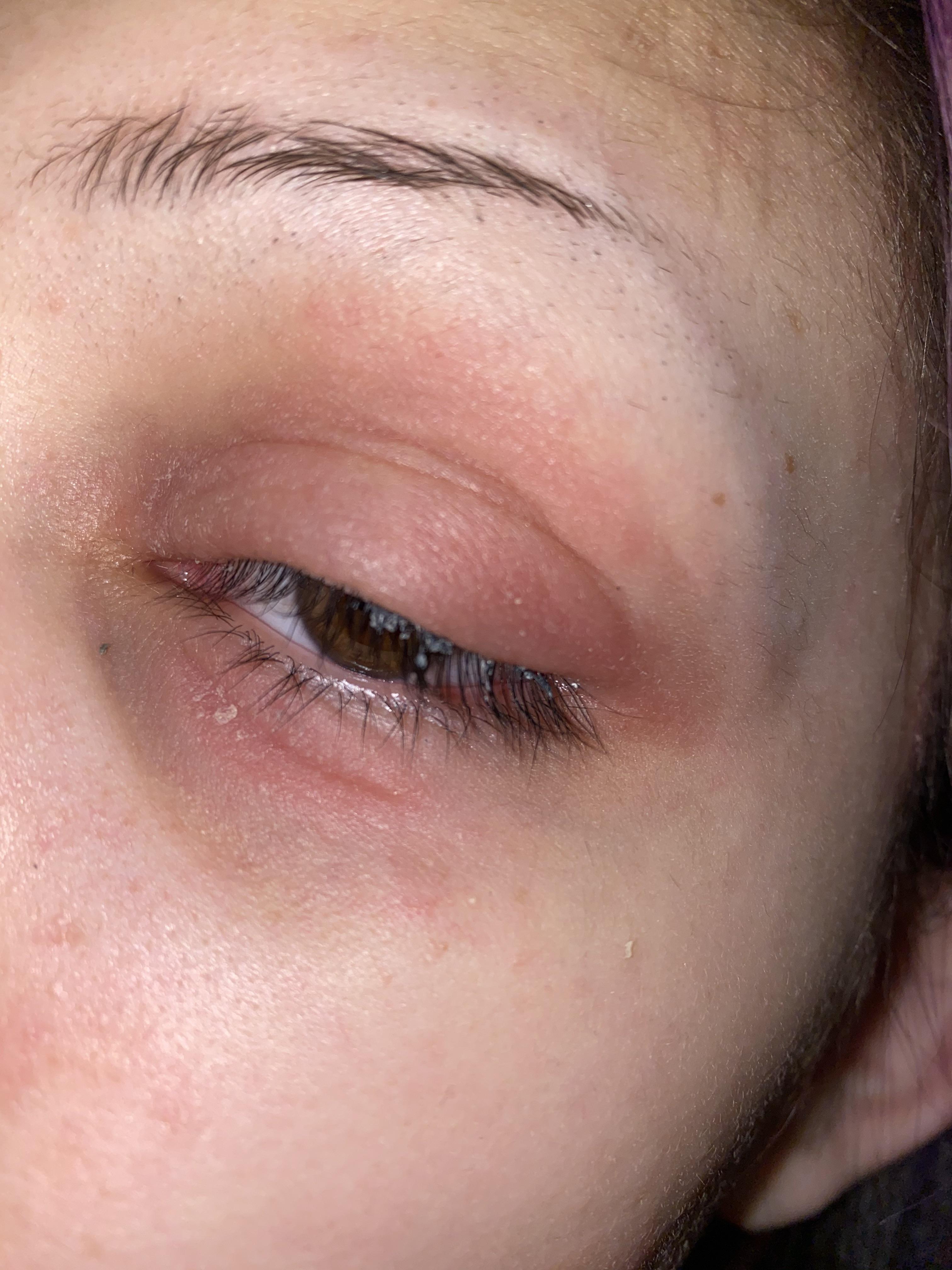 my eczema has caused swelling on my eyes, and it’s been freaking me out