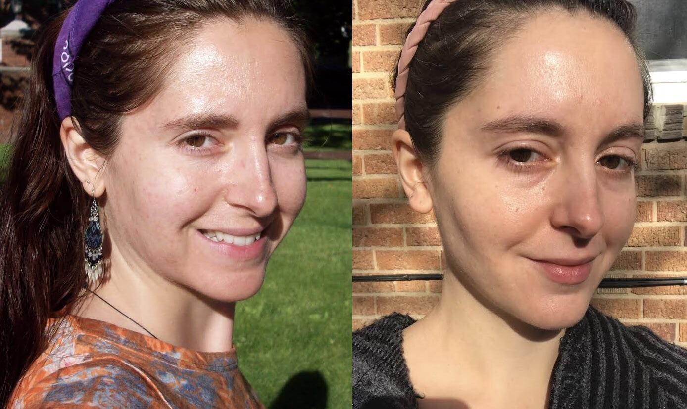 Coconut Oil For Skin Before And After