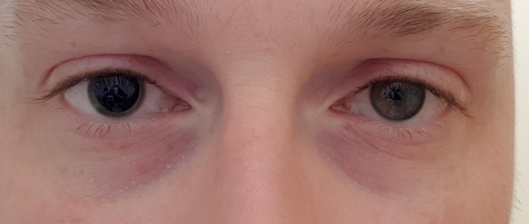 Single eye dilation mildlyinteresting