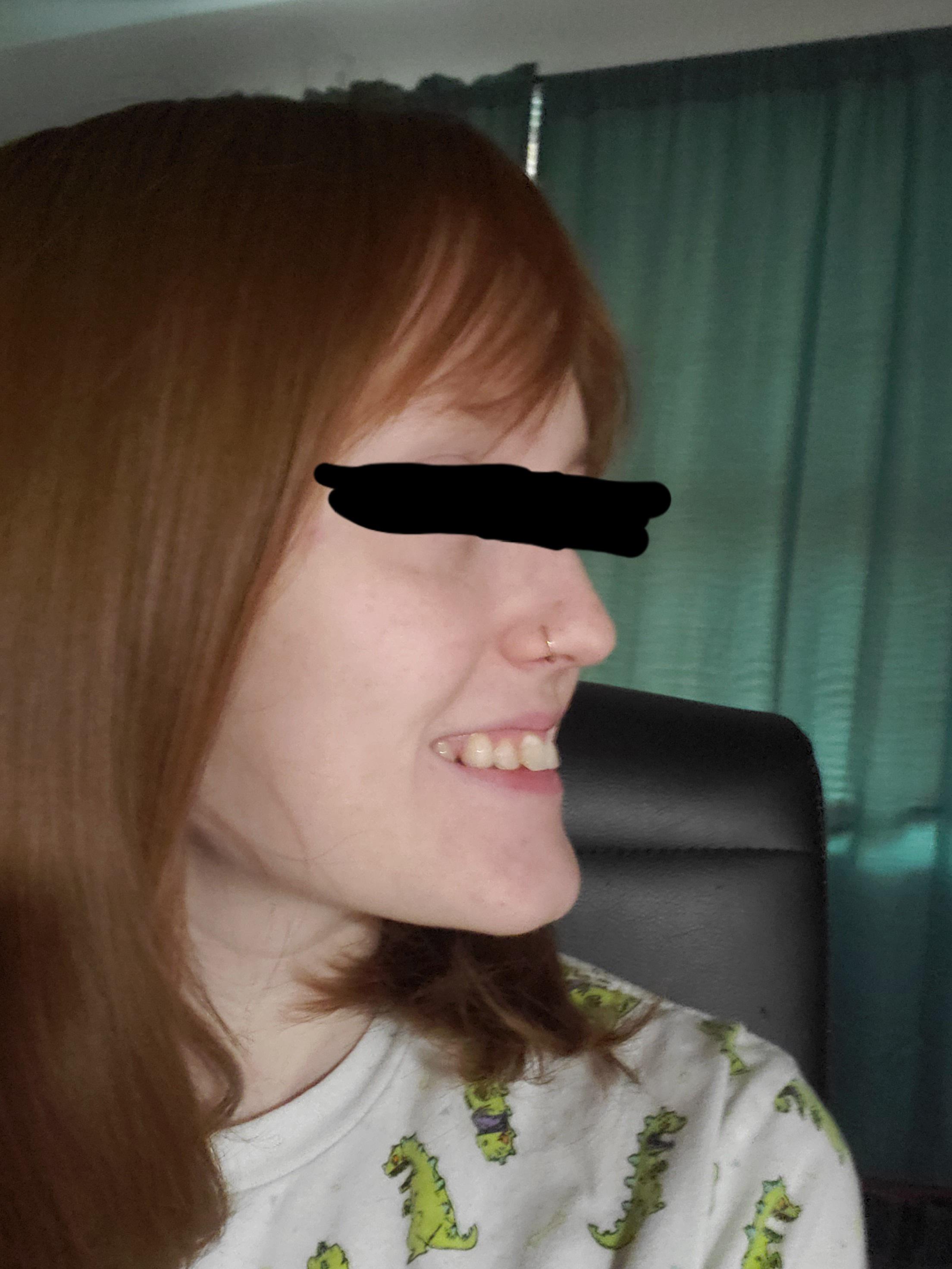 Would I benefit from jaw surgery? My chin juts out so much and I hate