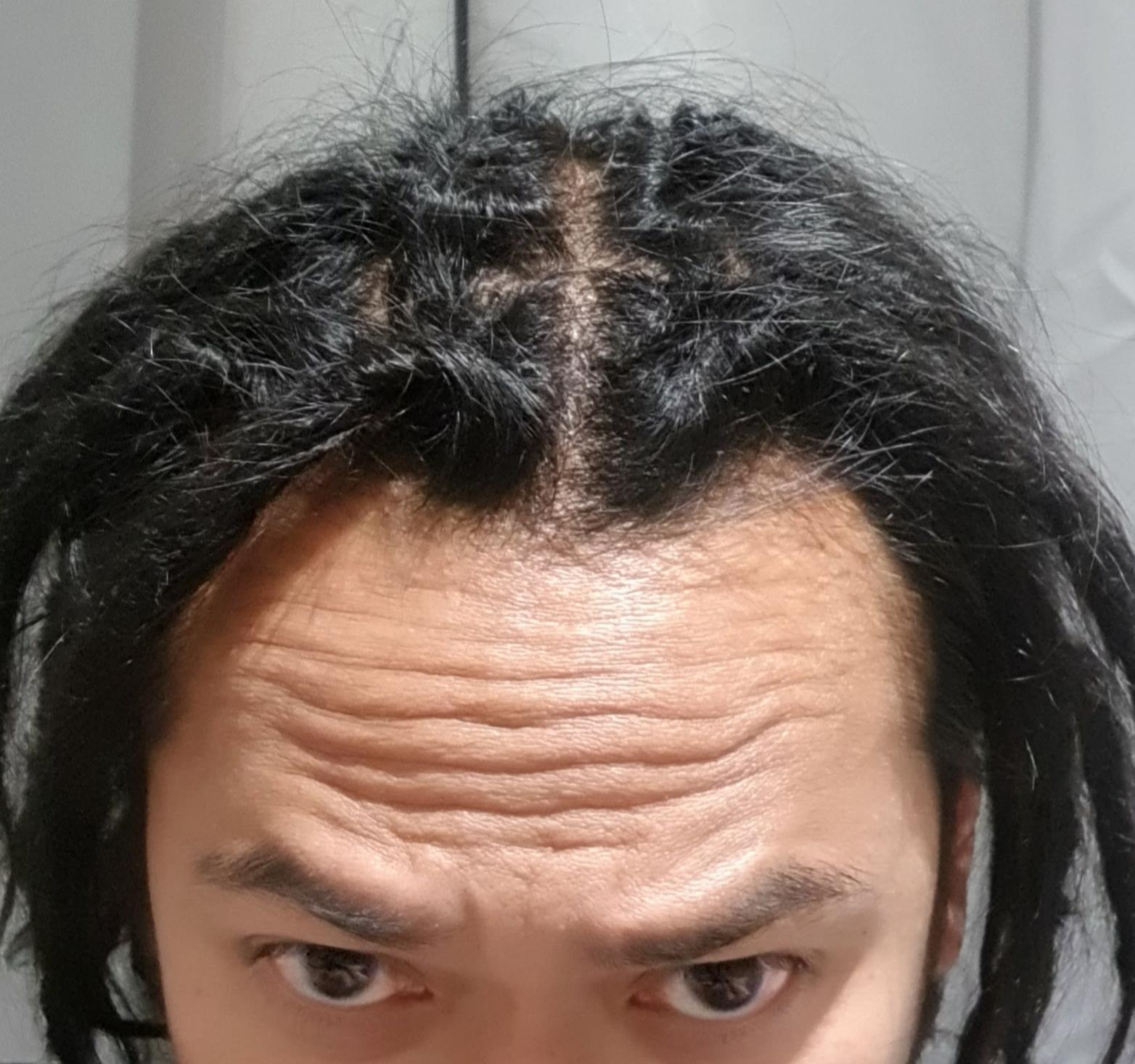 How ugly can the ugly stage get? 😆 Dreadlocks