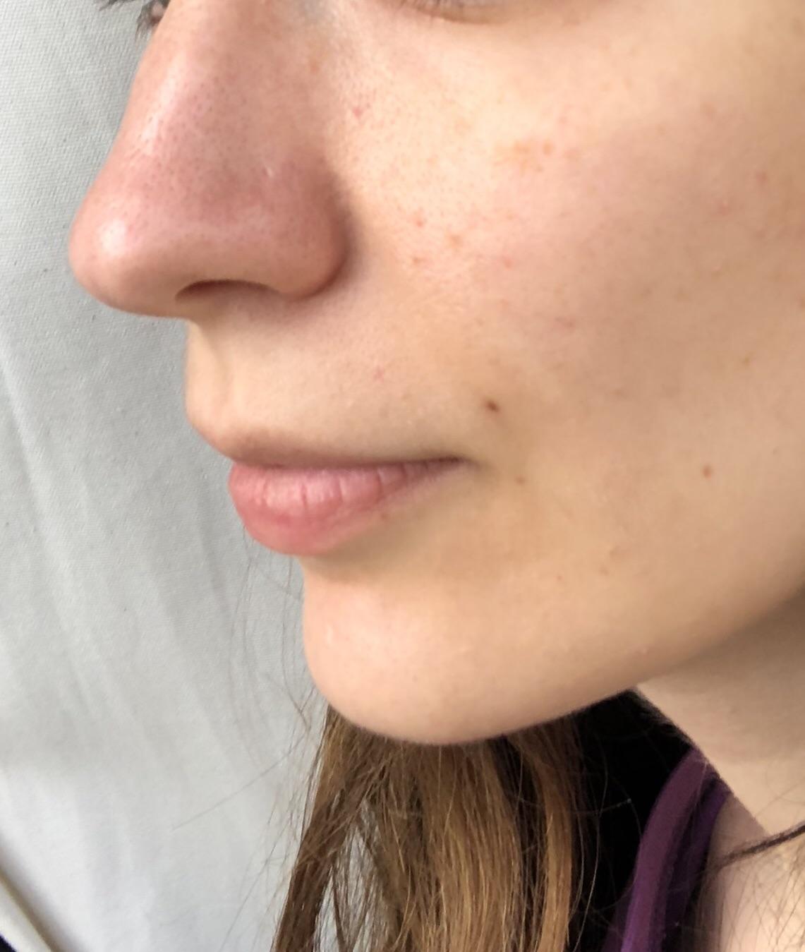 [skin concerns] My nose is more red than the rest of my face and has