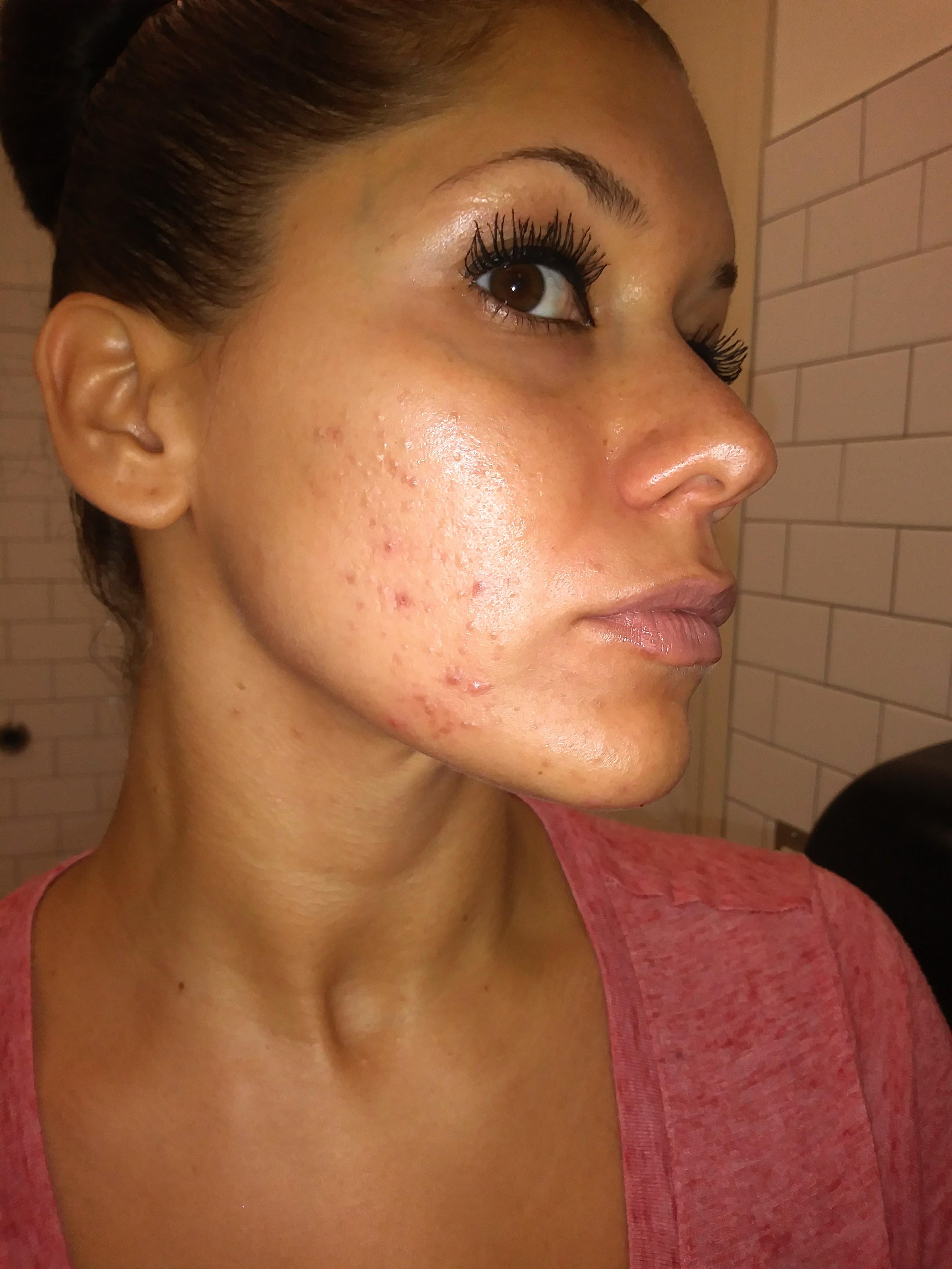 Update from last post. About 2.5 months on differin and my skin seems