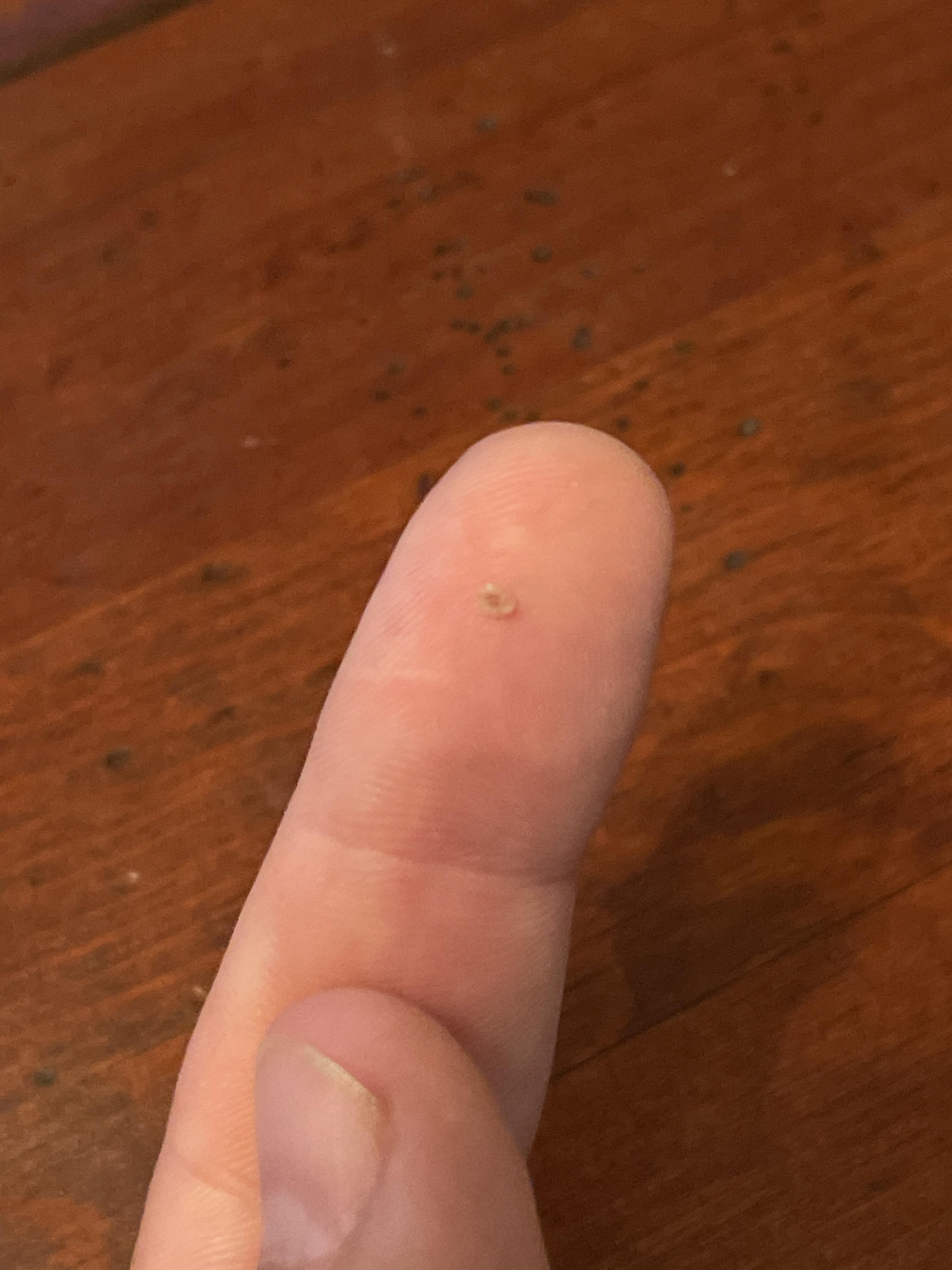 Share 142+ nail clippers skin tag reddit songngunhatanh.edu.vn