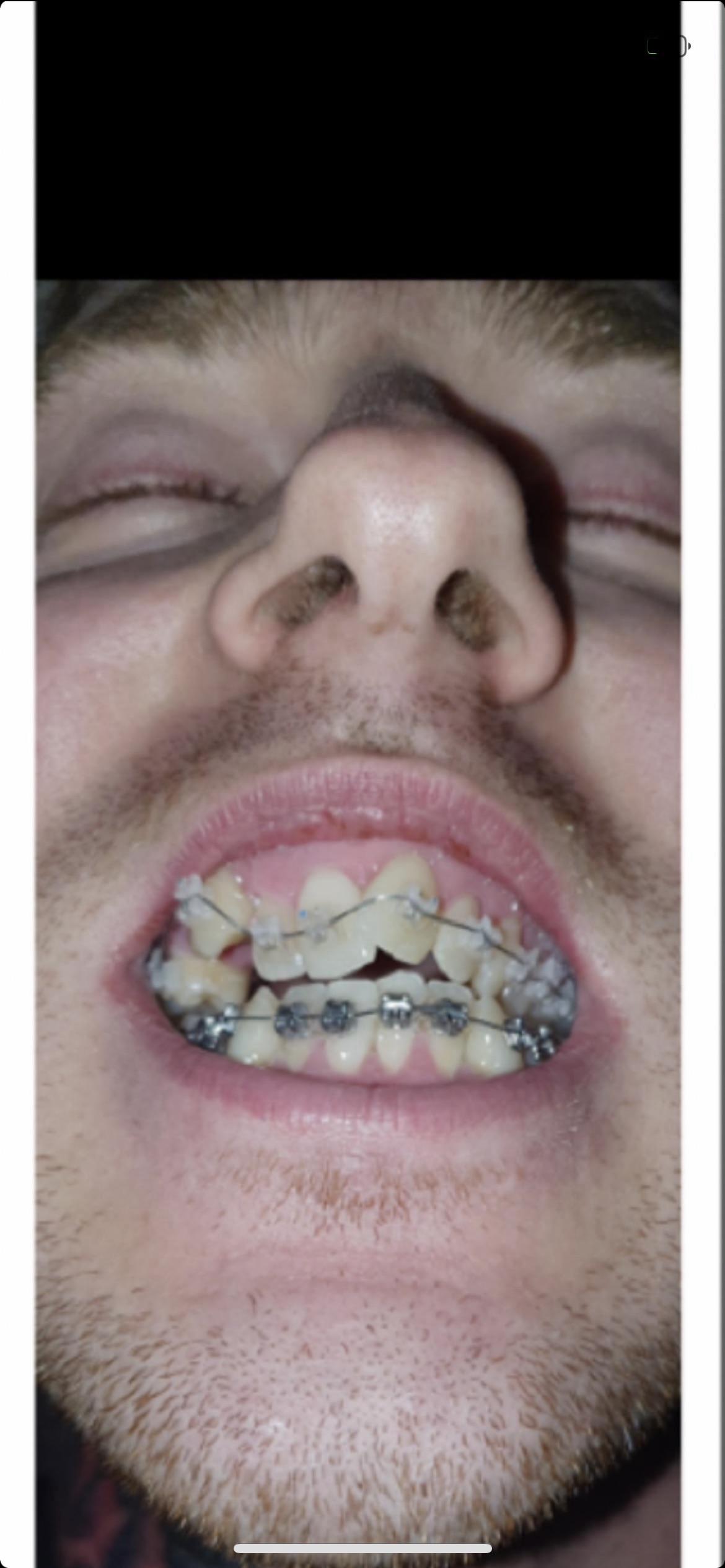 The Best Breezy Braces Review References