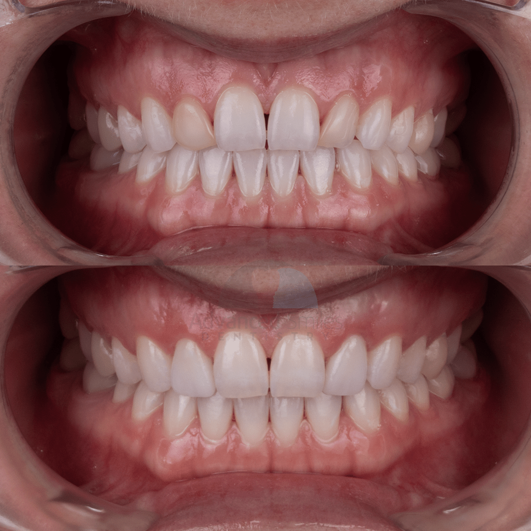 Porcelain veneers are the secret to achieving your perfect perfect