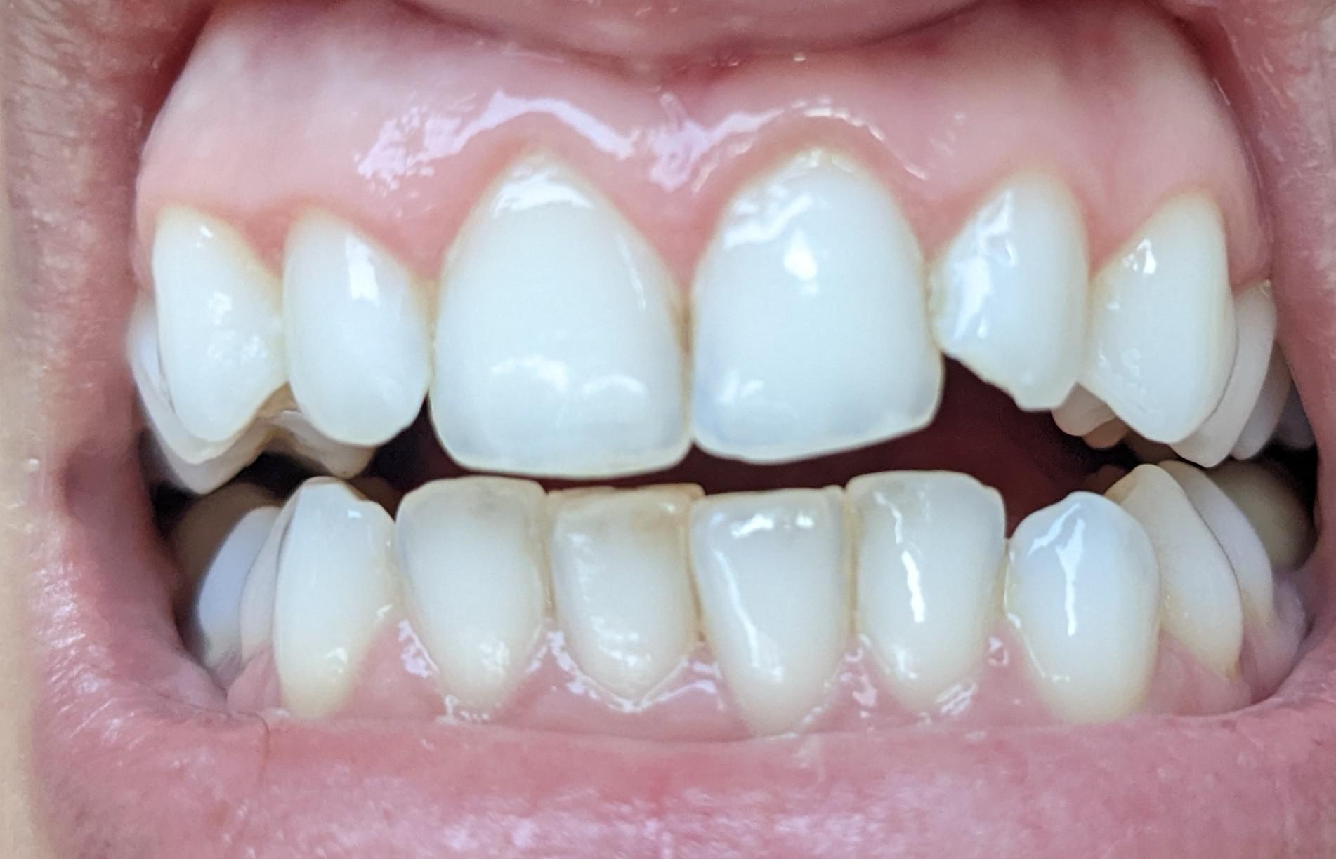 irritated gums for about 2 months post COVID19. I get dental cleanings