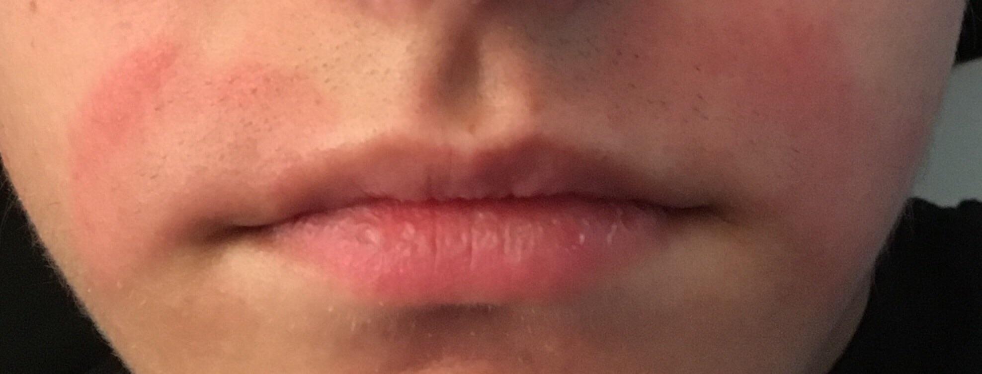 Benzoyl Peroxide Burn Treatment Quotes Viral Update