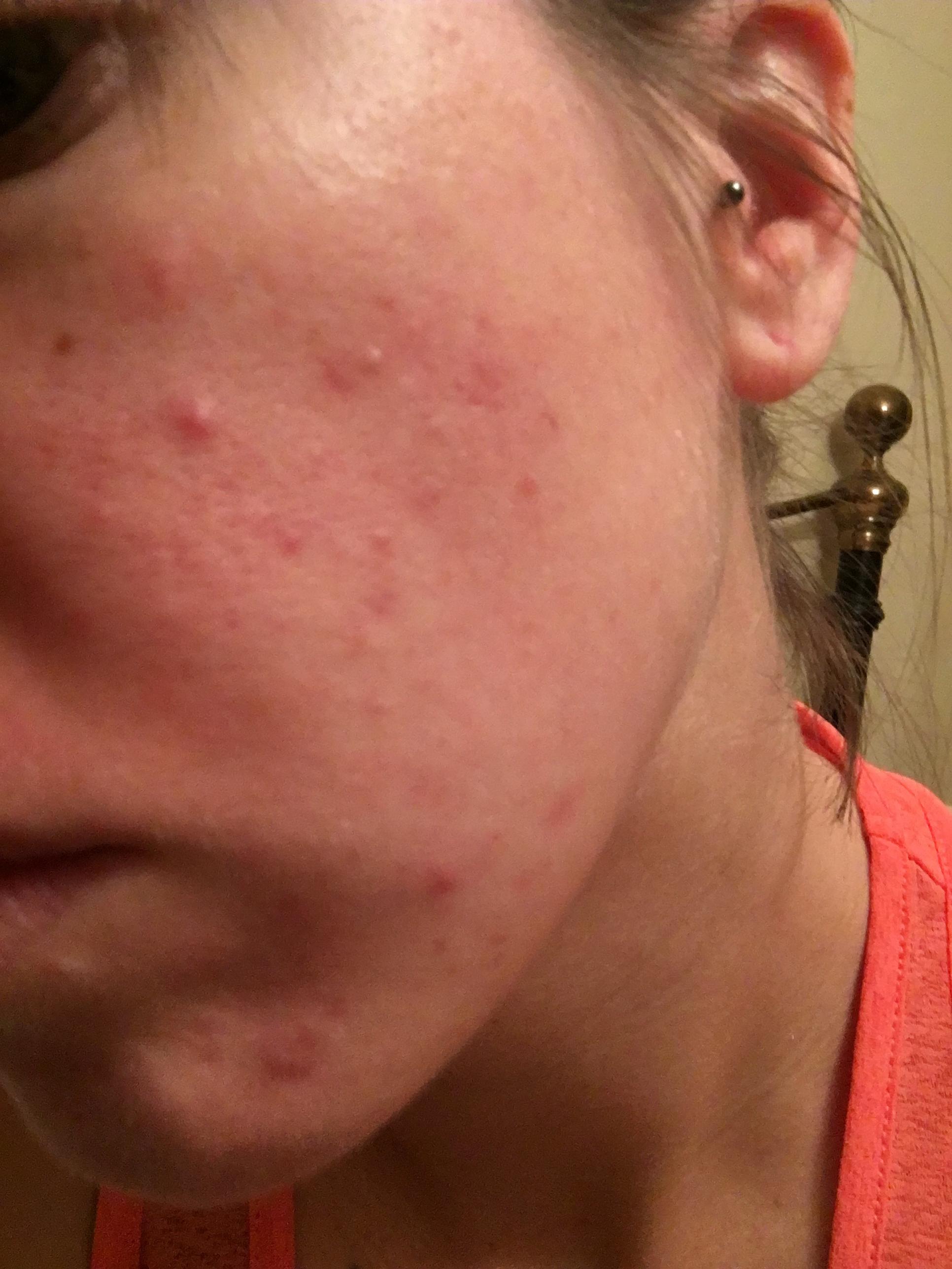 [skin concerns] Texture, large pores, redness, scarring and acne. Help