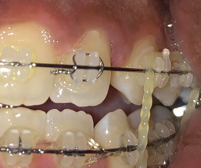 Not My Braces What is The Spiral Attachment Between the Upper and