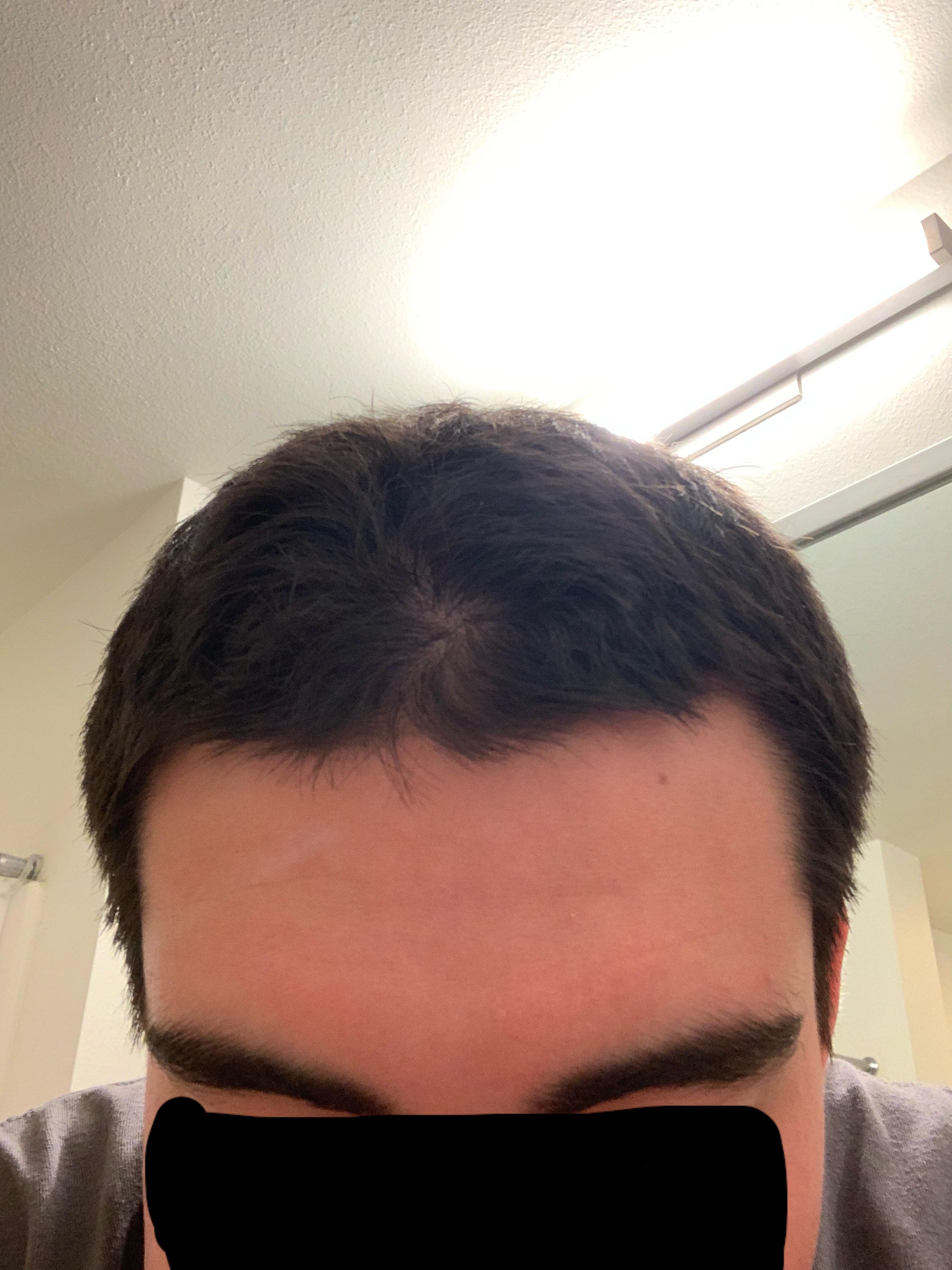 I have a cowlick at the front of my head r/mildlyinteresting