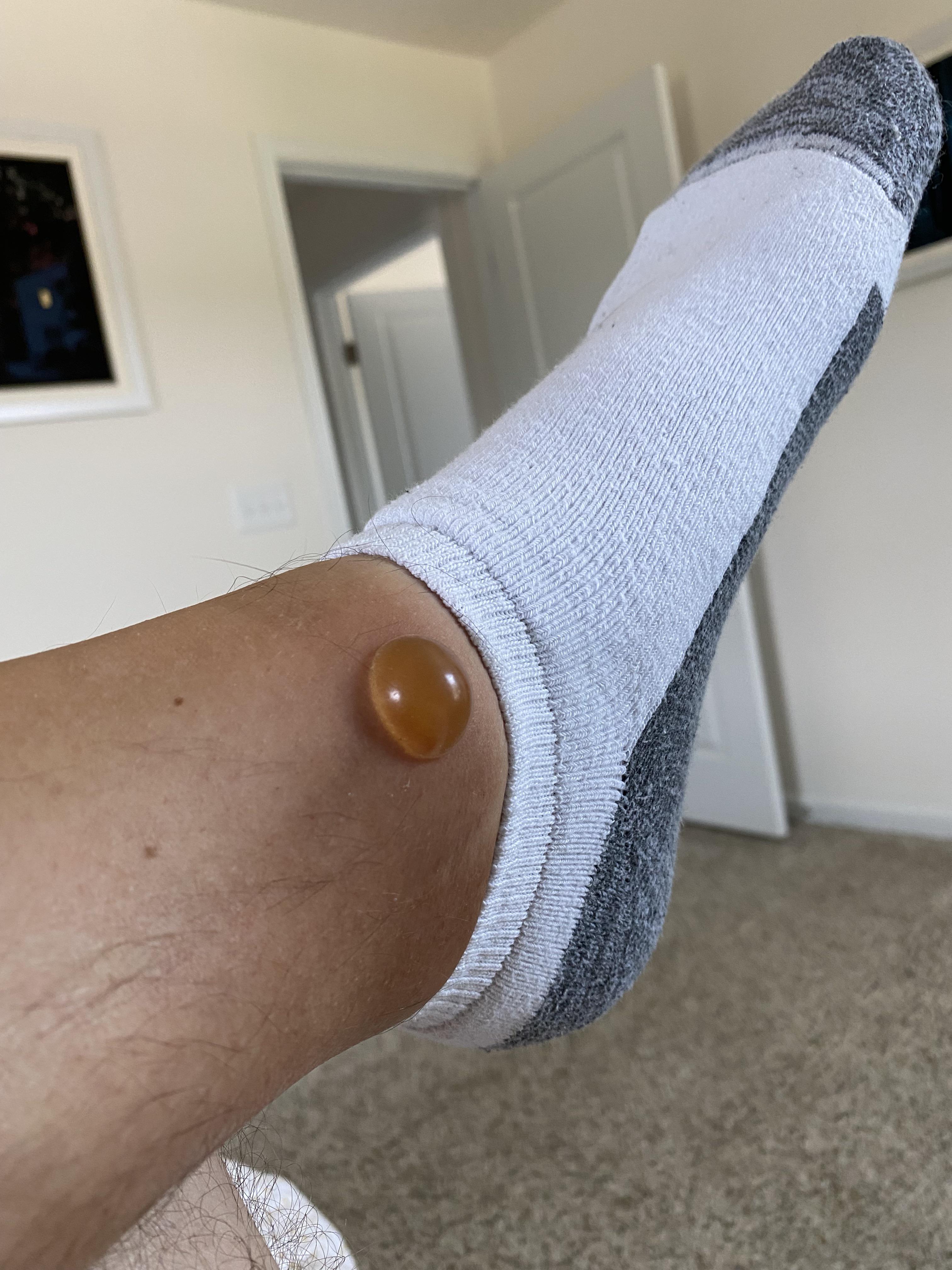 What Is Biting Me At Night In My Bed It Swells And Itches