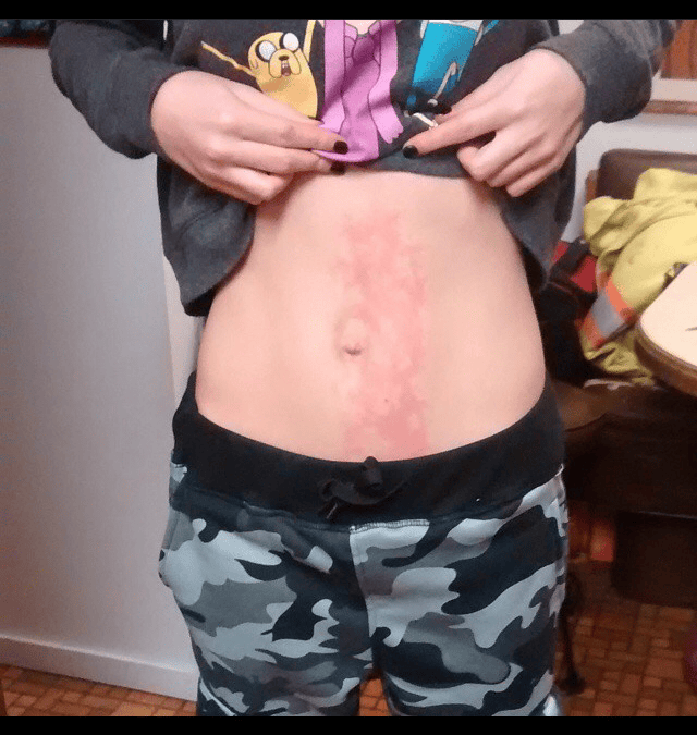 Toasted Skin Syndrome Reddit Decorative Journals