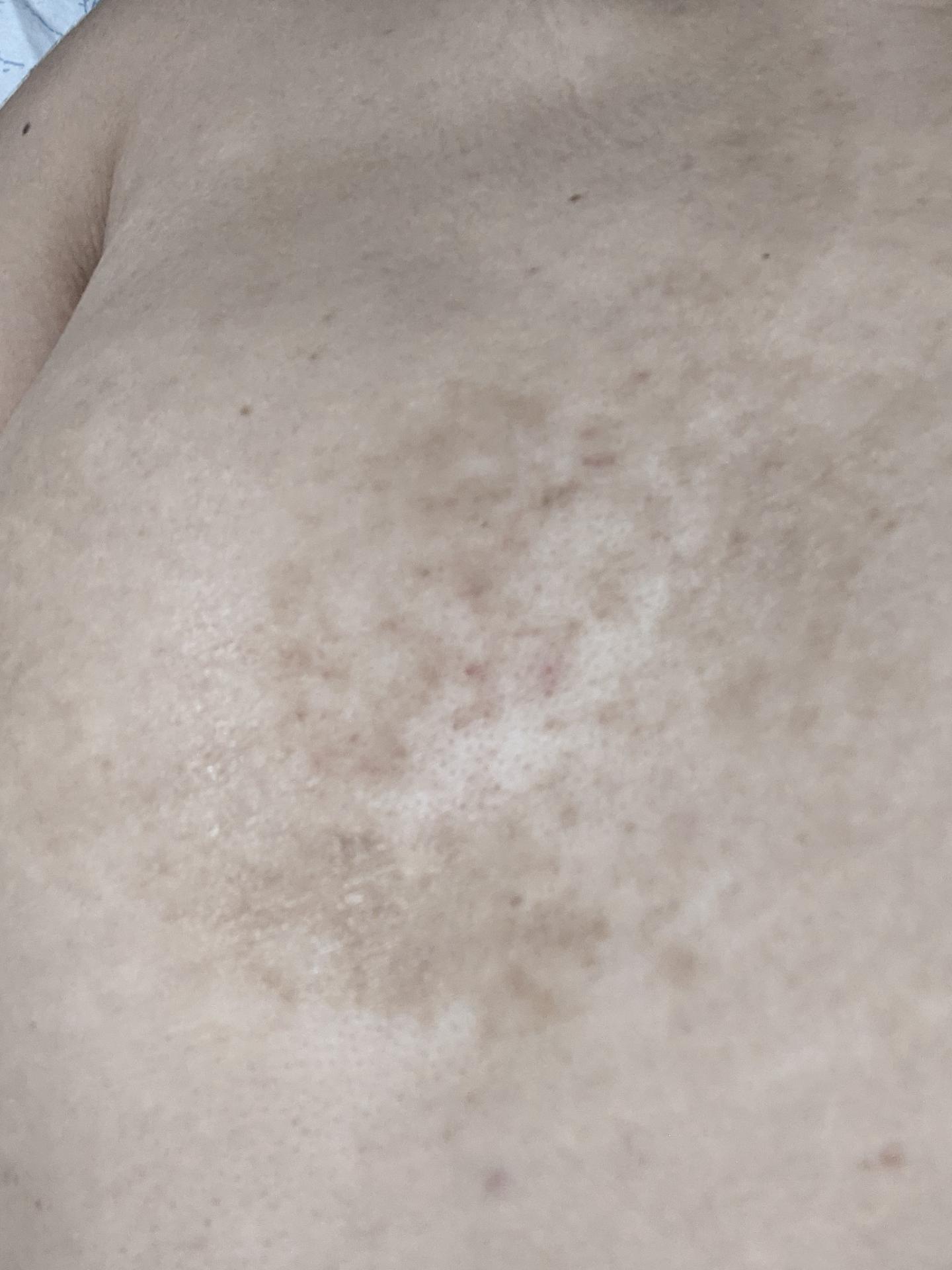 Chest redness/patches/discoloration r/Dermatology