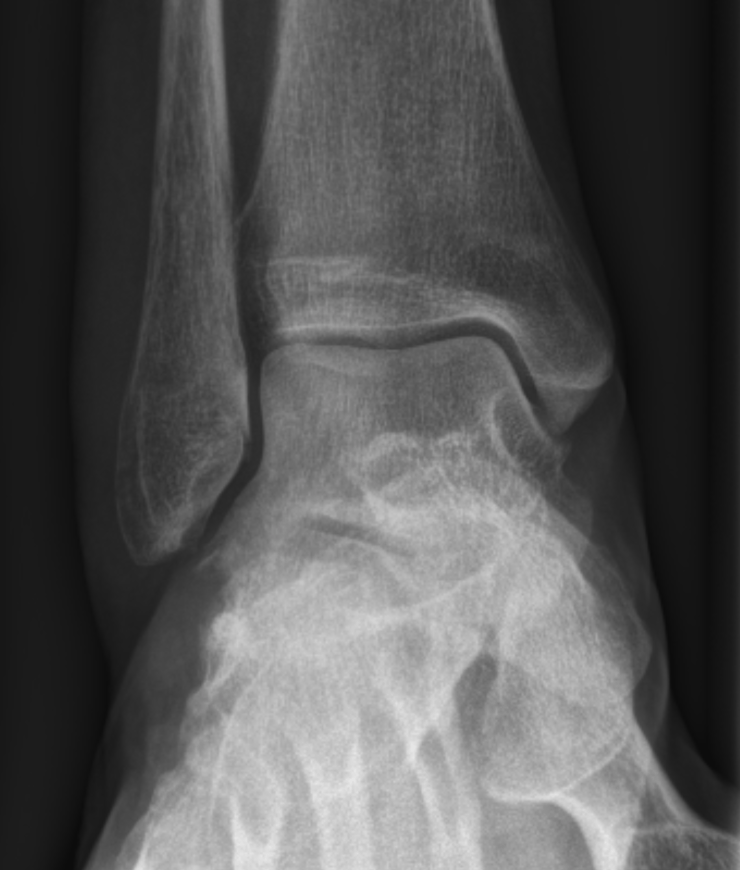 Distorsiyon Tıp Dilinde Nedir? • Dr. Erhan Yavuz