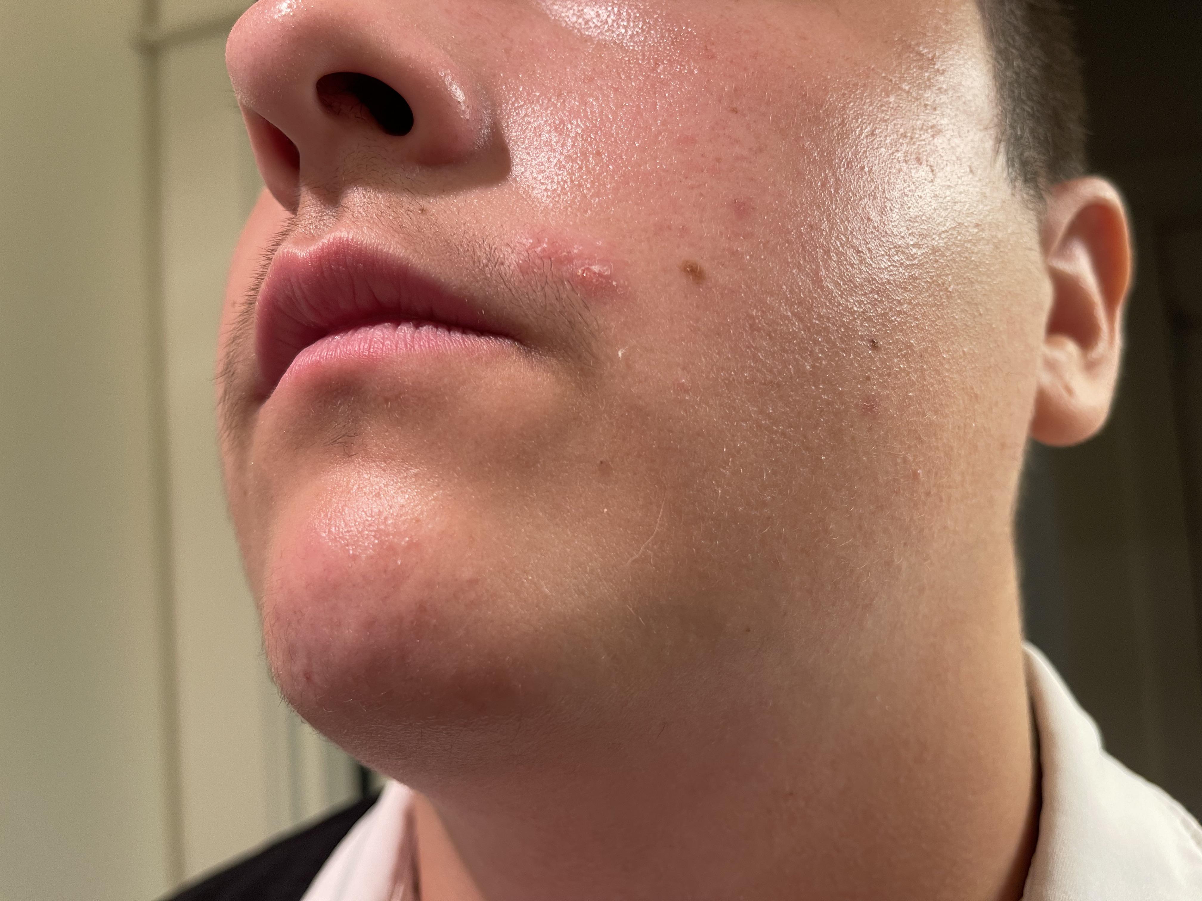 Oozing rash on face. Not the best picture but it burns when he touches