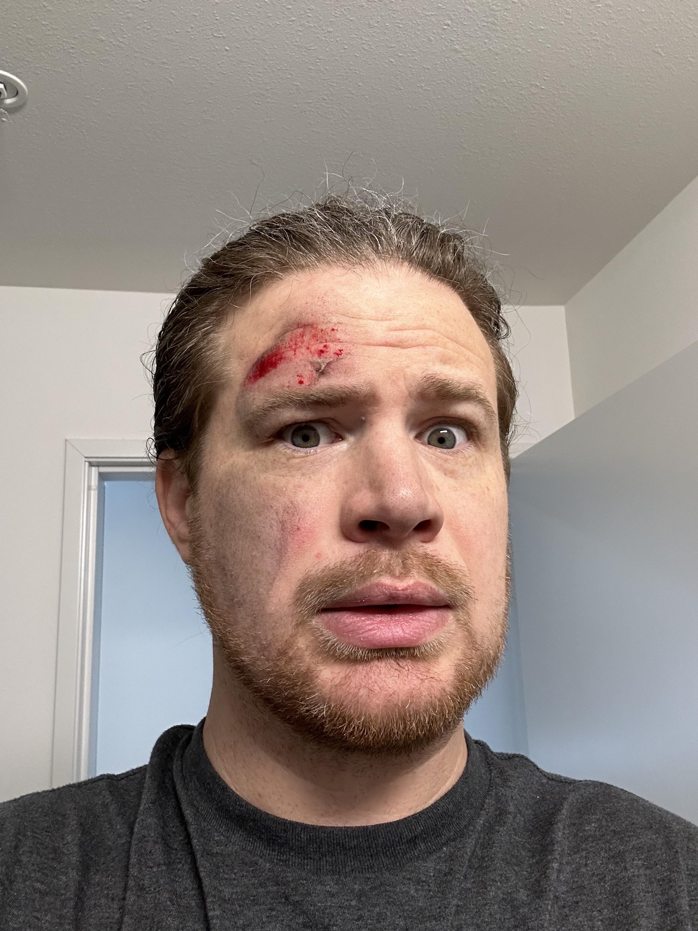 5mph fall direct to face plant r/onewheel