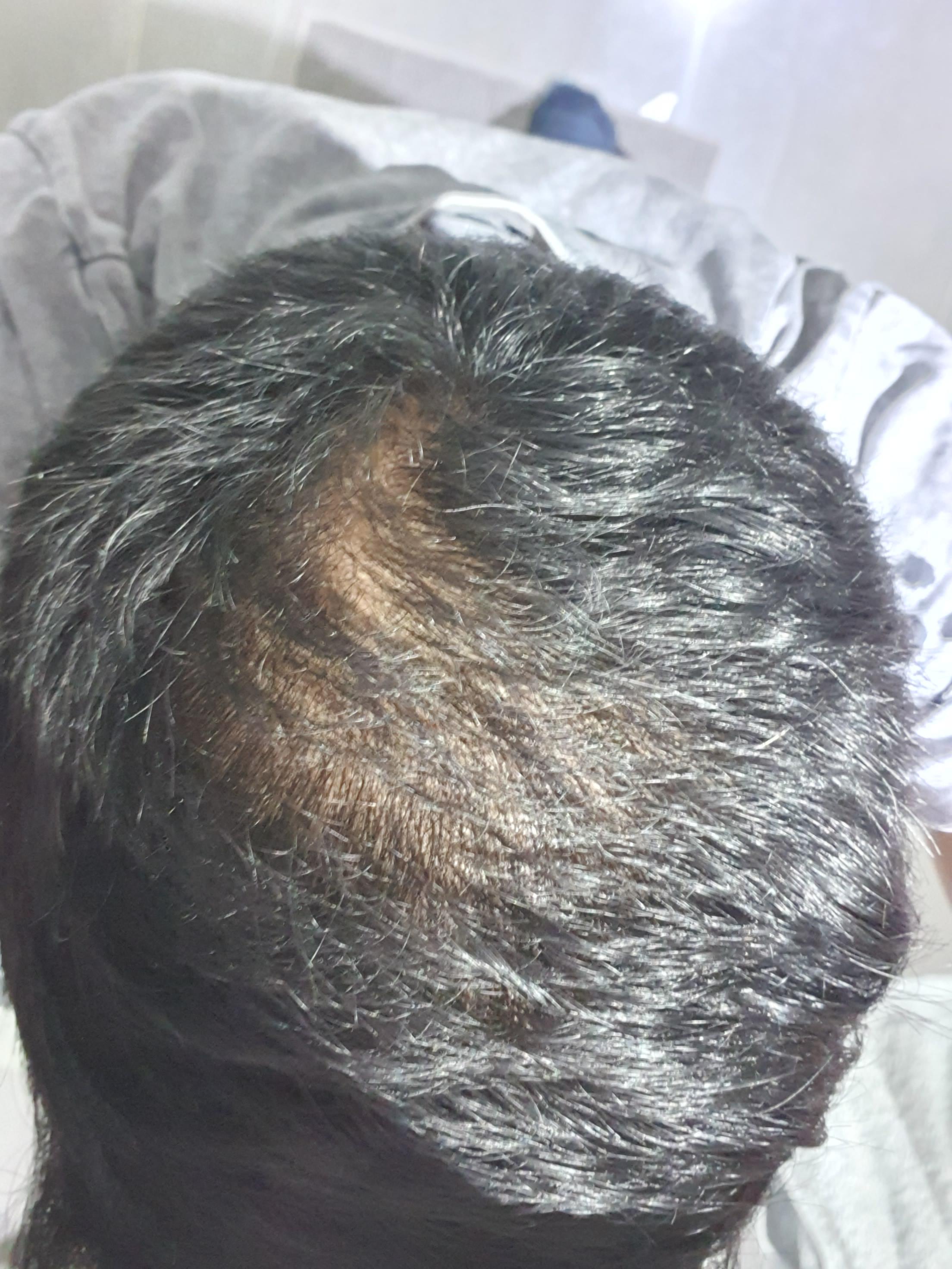 Is my crown normal or thinning? Hairloss