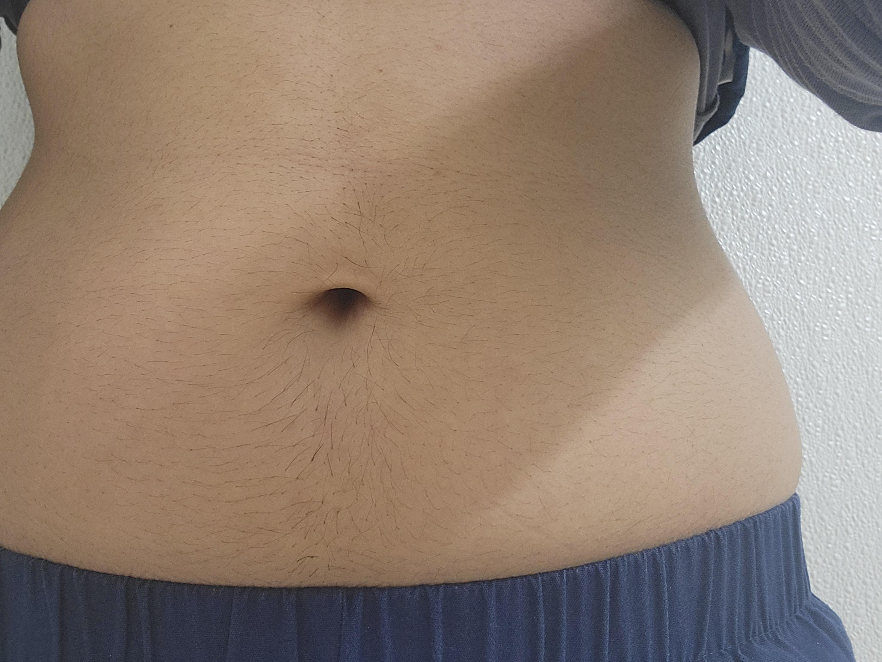Hirsutism Stomach