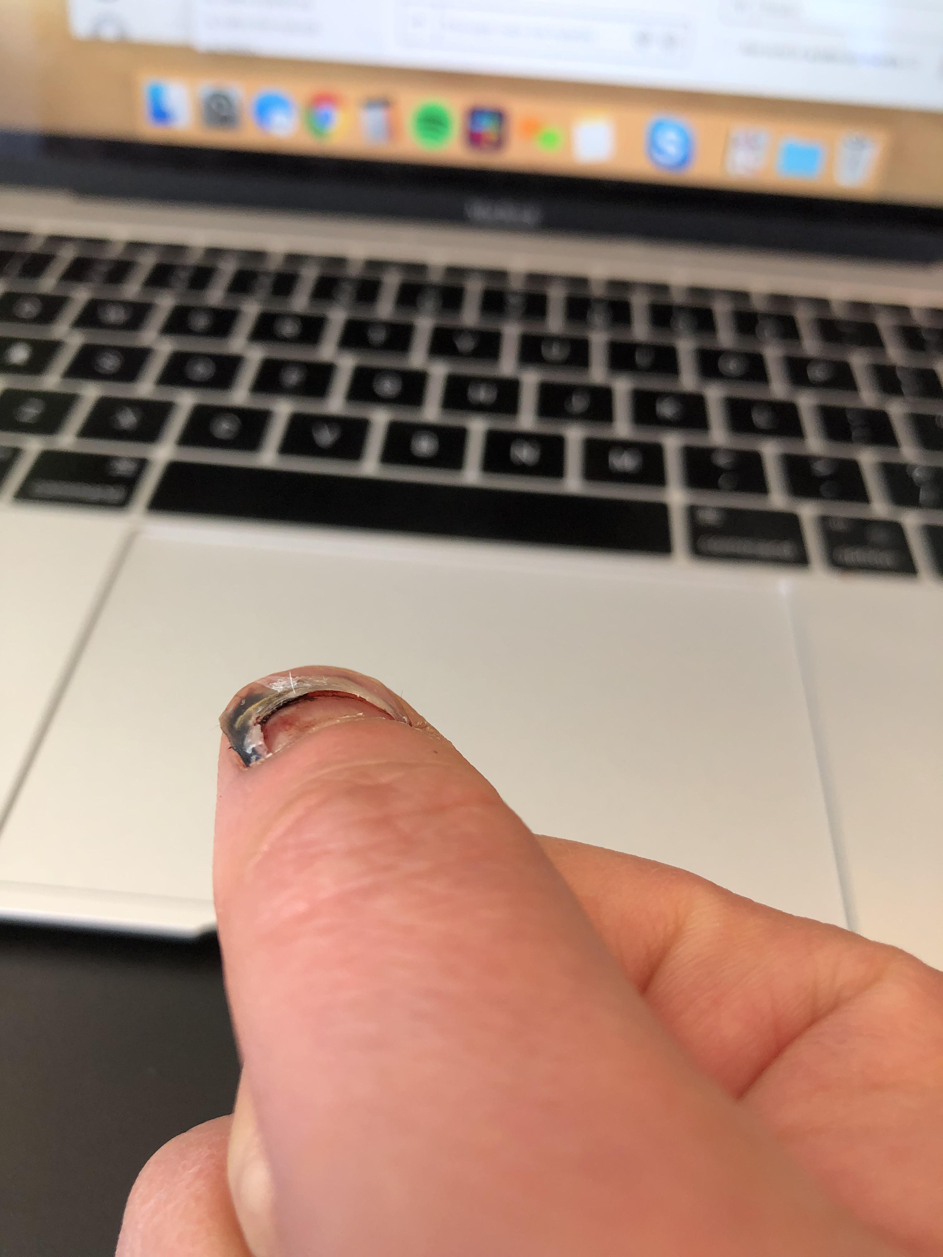 New nail growing under old nail making an air bubble in between r