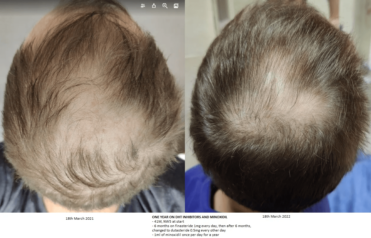 One year of hair loss medication progress pic what next? malehairadvice