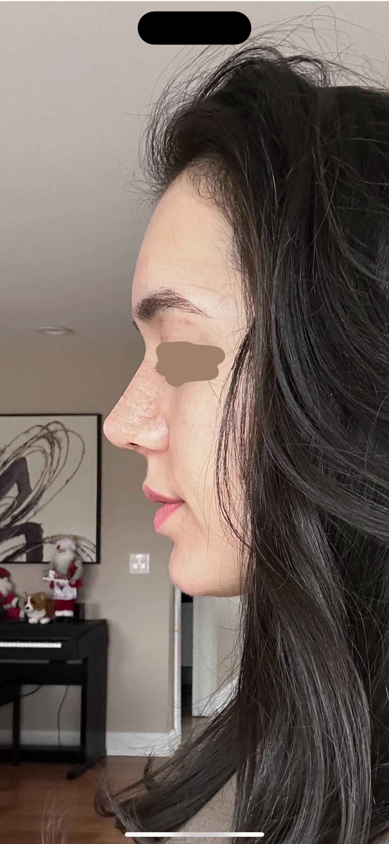 Wearing glasses after rhinoplasty how long did you wait? r