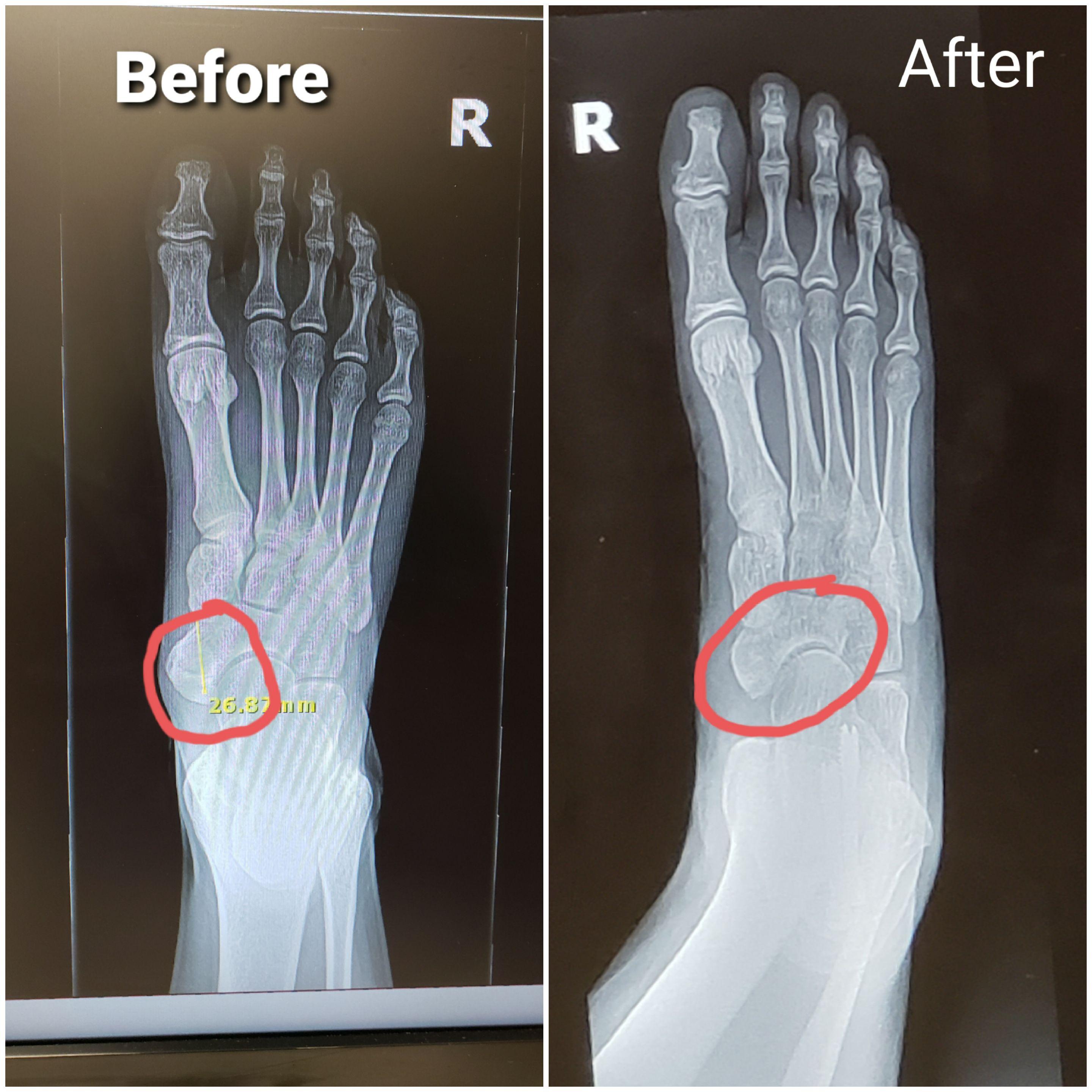 My Accessory Navicular in my RT foot before and after surgery. r