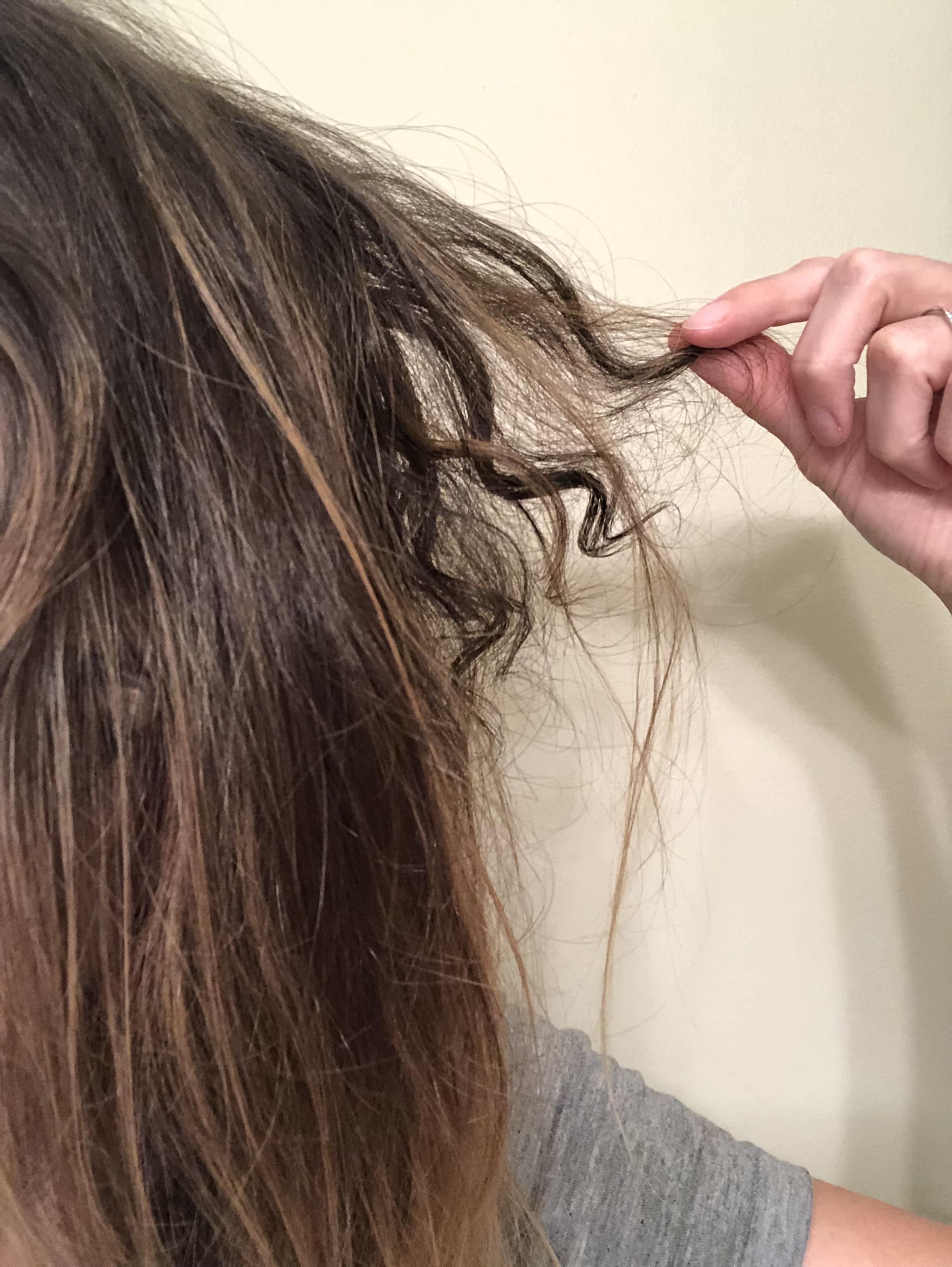 Will Hair Grow Back After Pilar Cyst Removal Details Of the 70