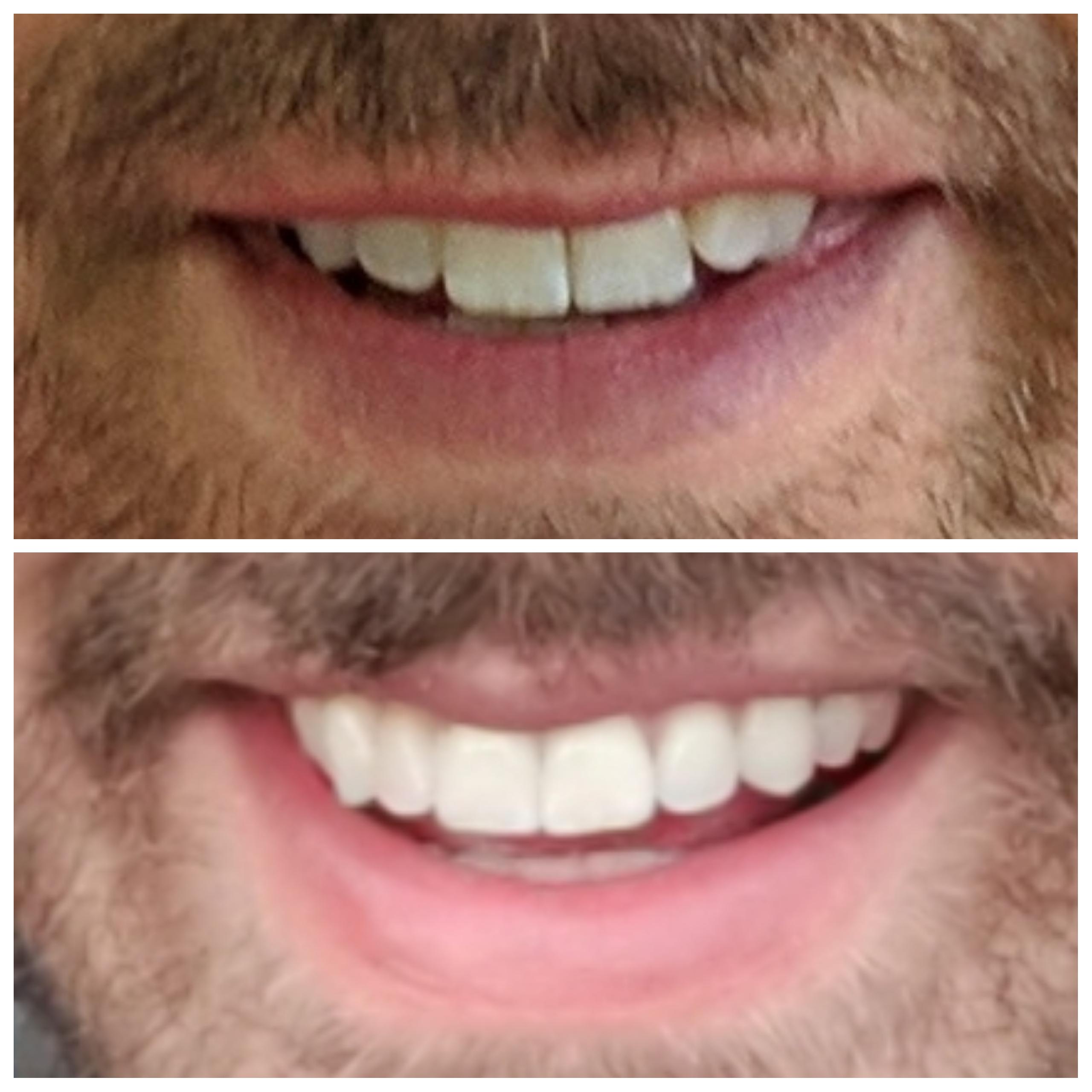 Lingual braces have been amazing because I get to see the progress