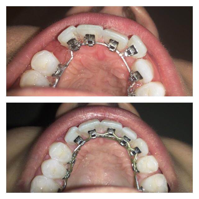 Lingual Braces Cost