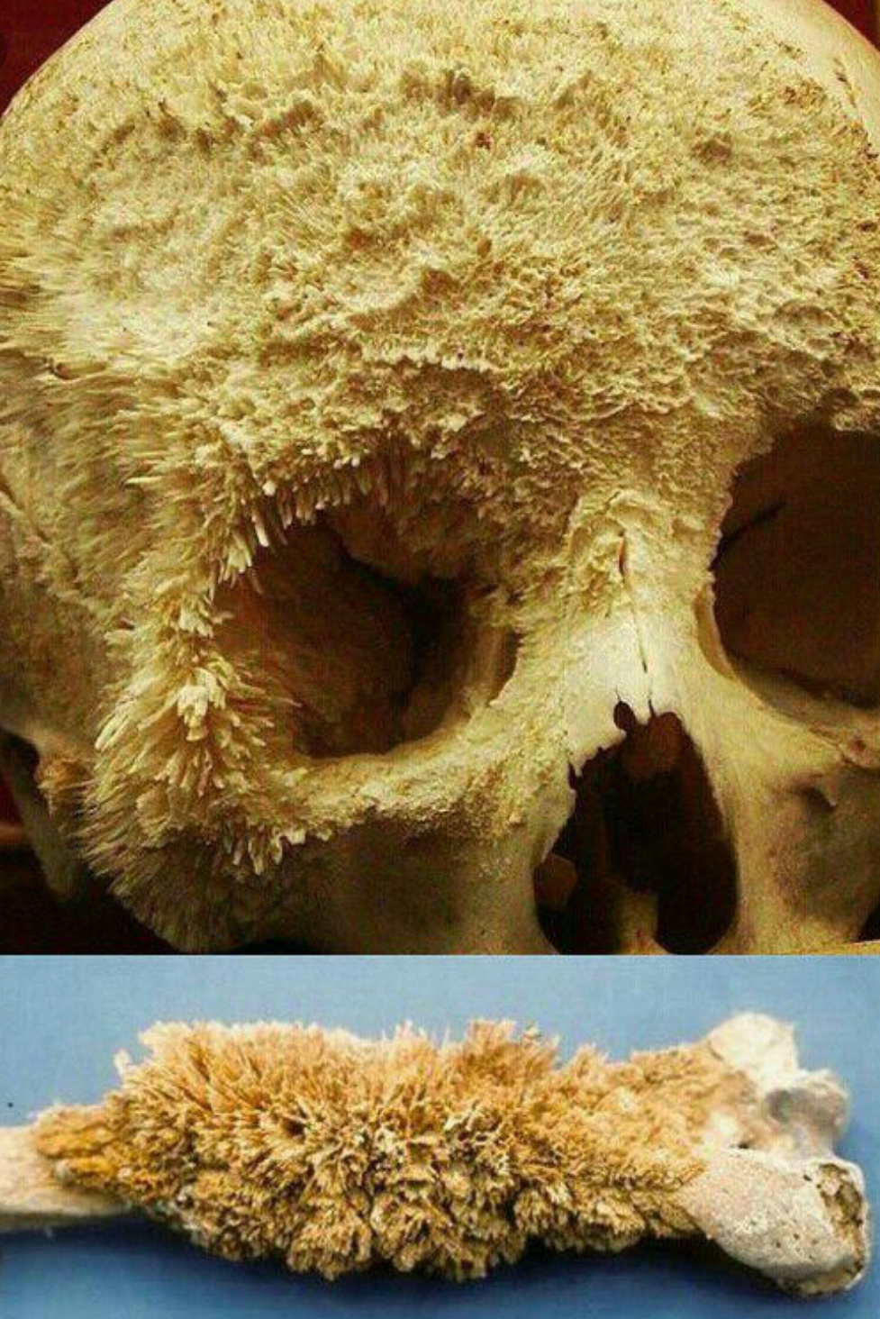 Bone cancer Damnthatsinteresting