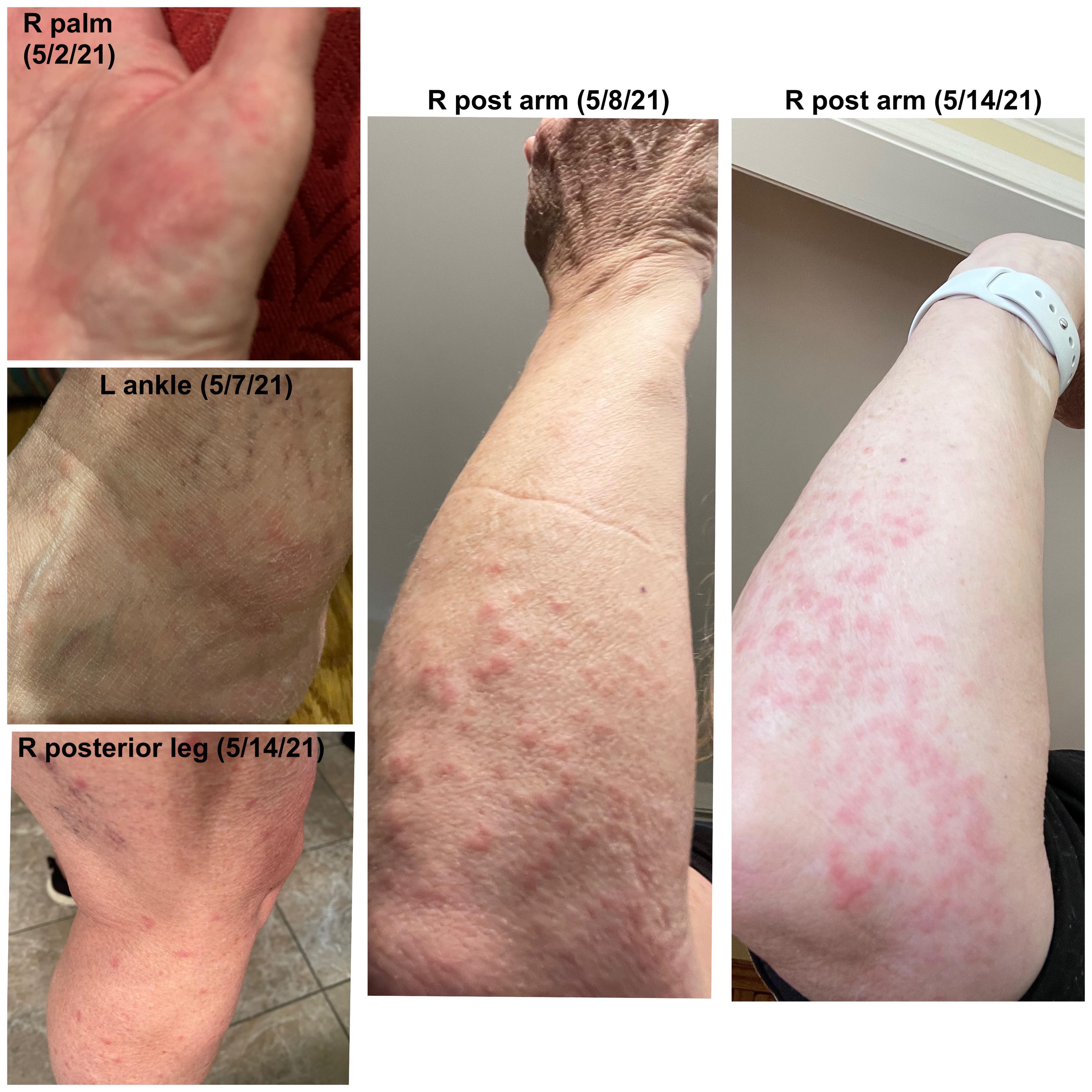 Rash and joint pain r/Dermatology