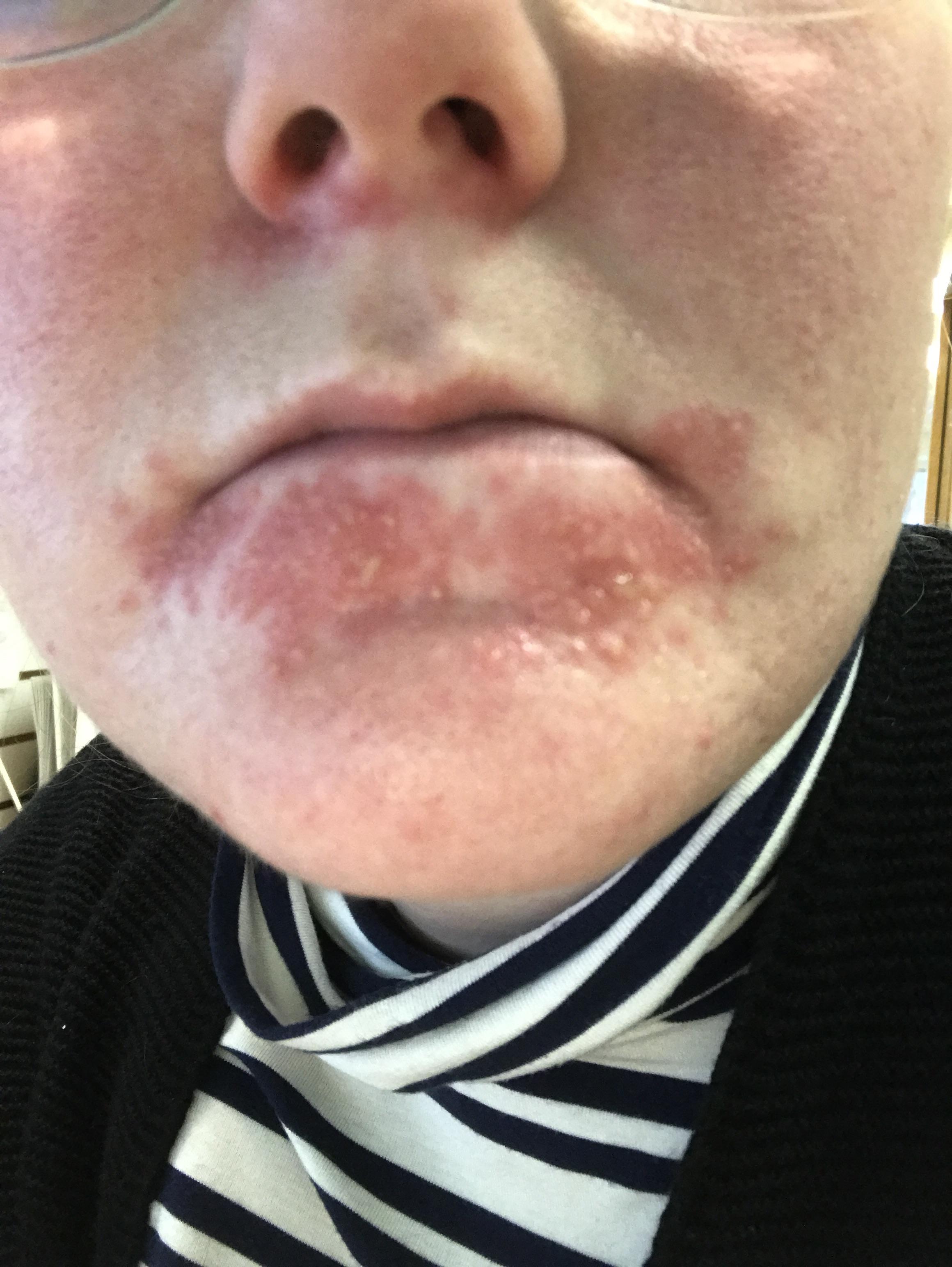 Perioral Dermatitis r/popping