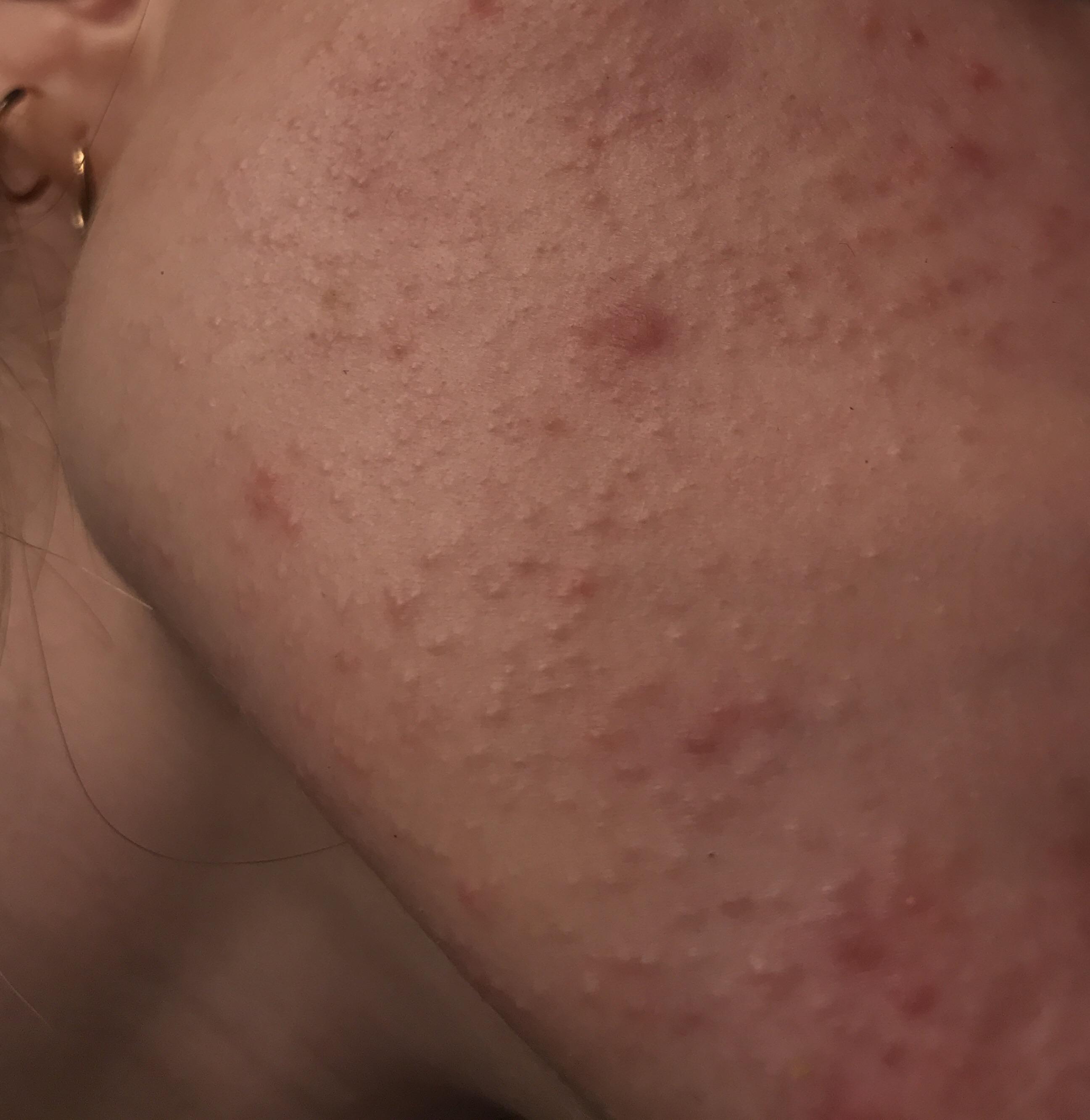 [Skin Concerns] Struggling with continuously worsening skin texture