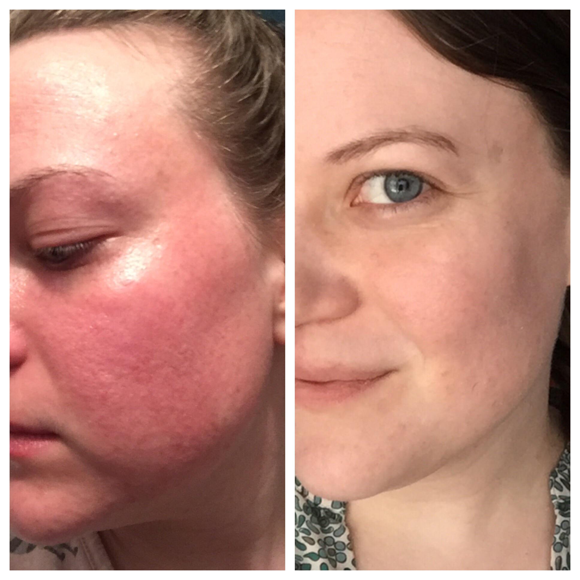 Success! Beyond thankful for the relief. Benzoyl peroxide and vitamin E