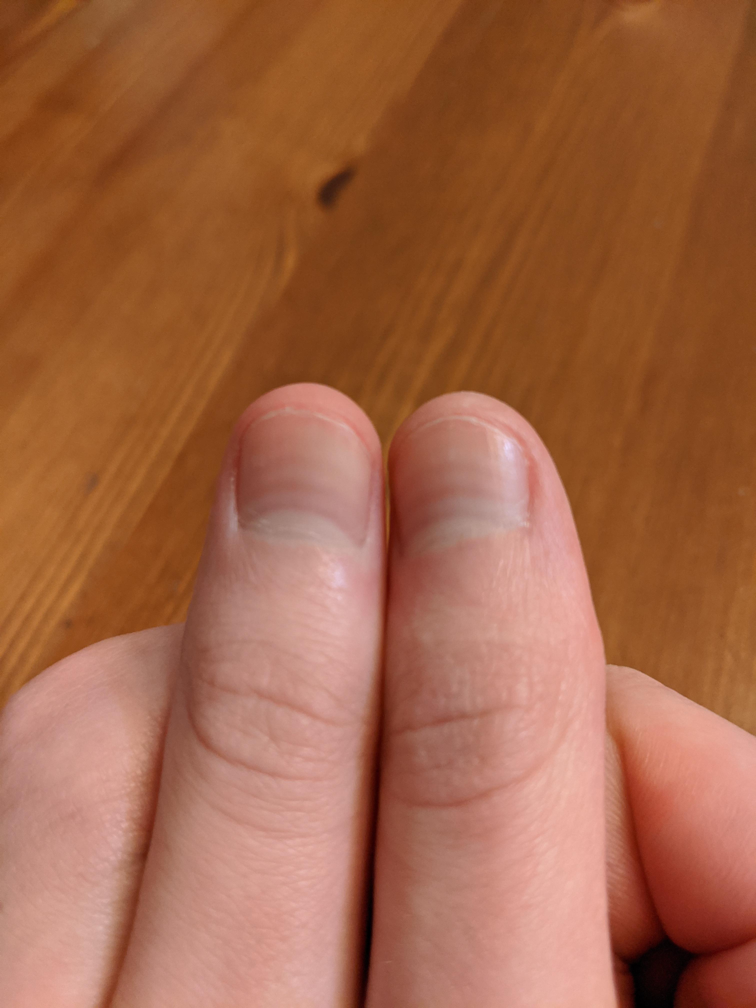 My fingernails have stripes where they temporarily stopped growing. One