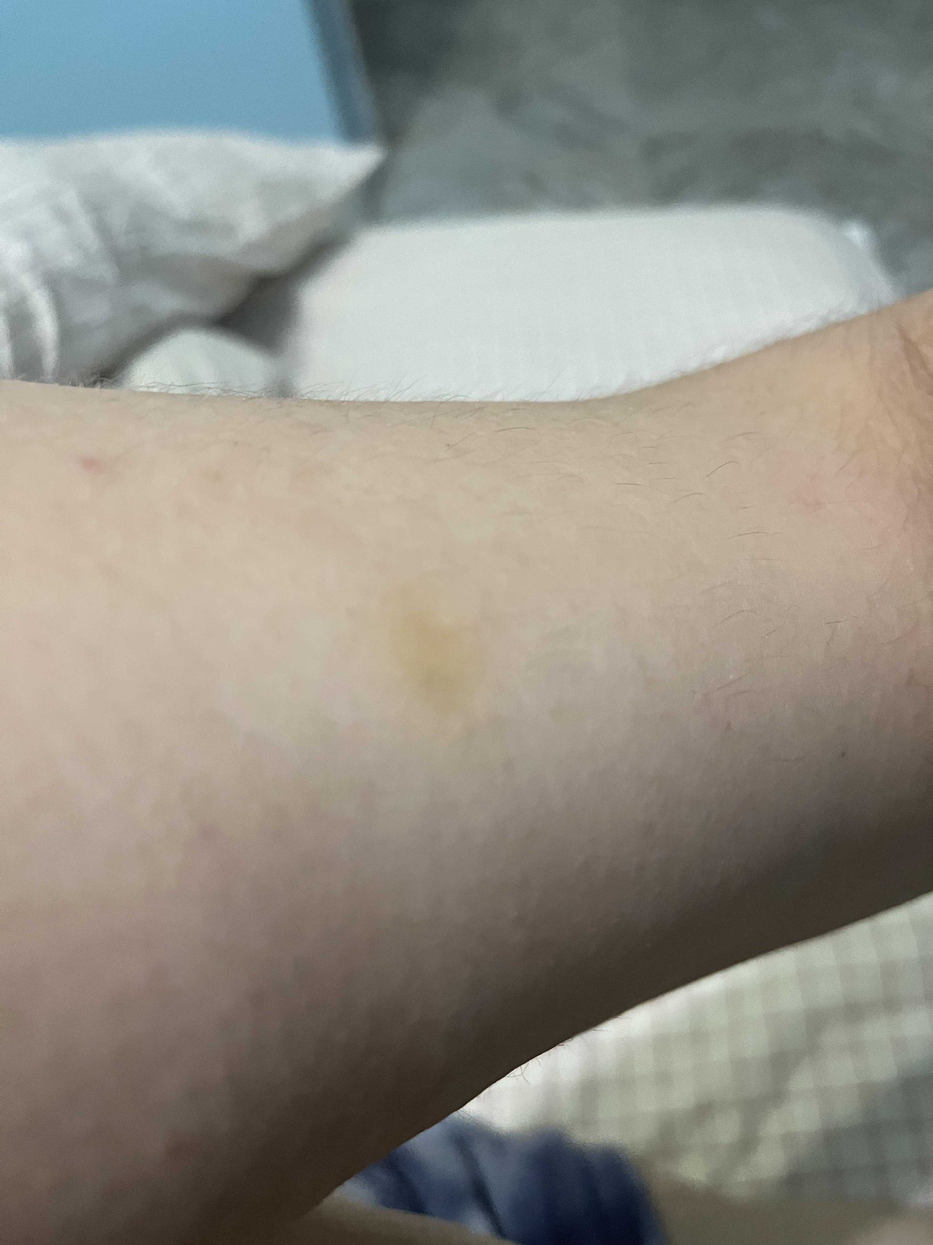 Did anyone get a yellow spots around body after starting humira? How