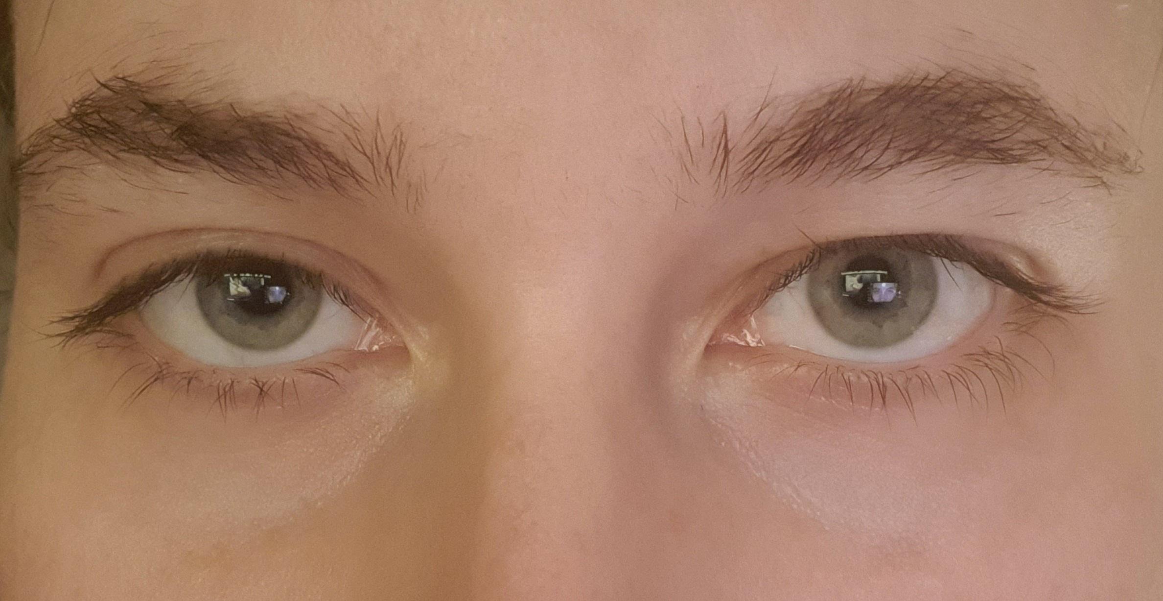 My right eye has a lot more hooded in the last 2 years, I'm only