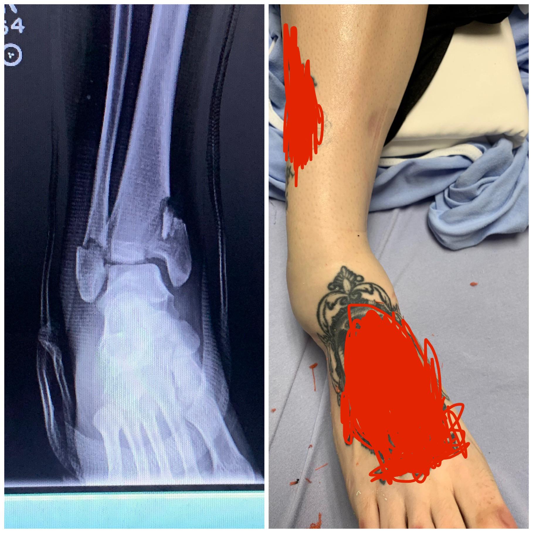 Bimalleolar fracture sustained while rock climbing. One of the worst