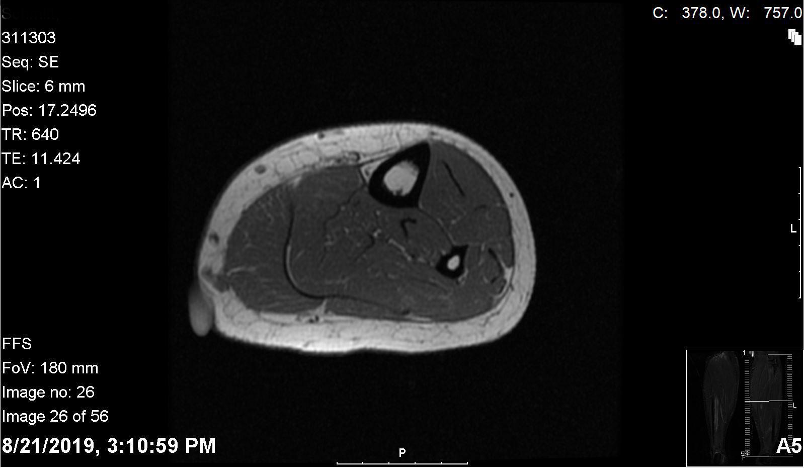 Mystery lesion on the lower interior left calf. I have been told it’s a