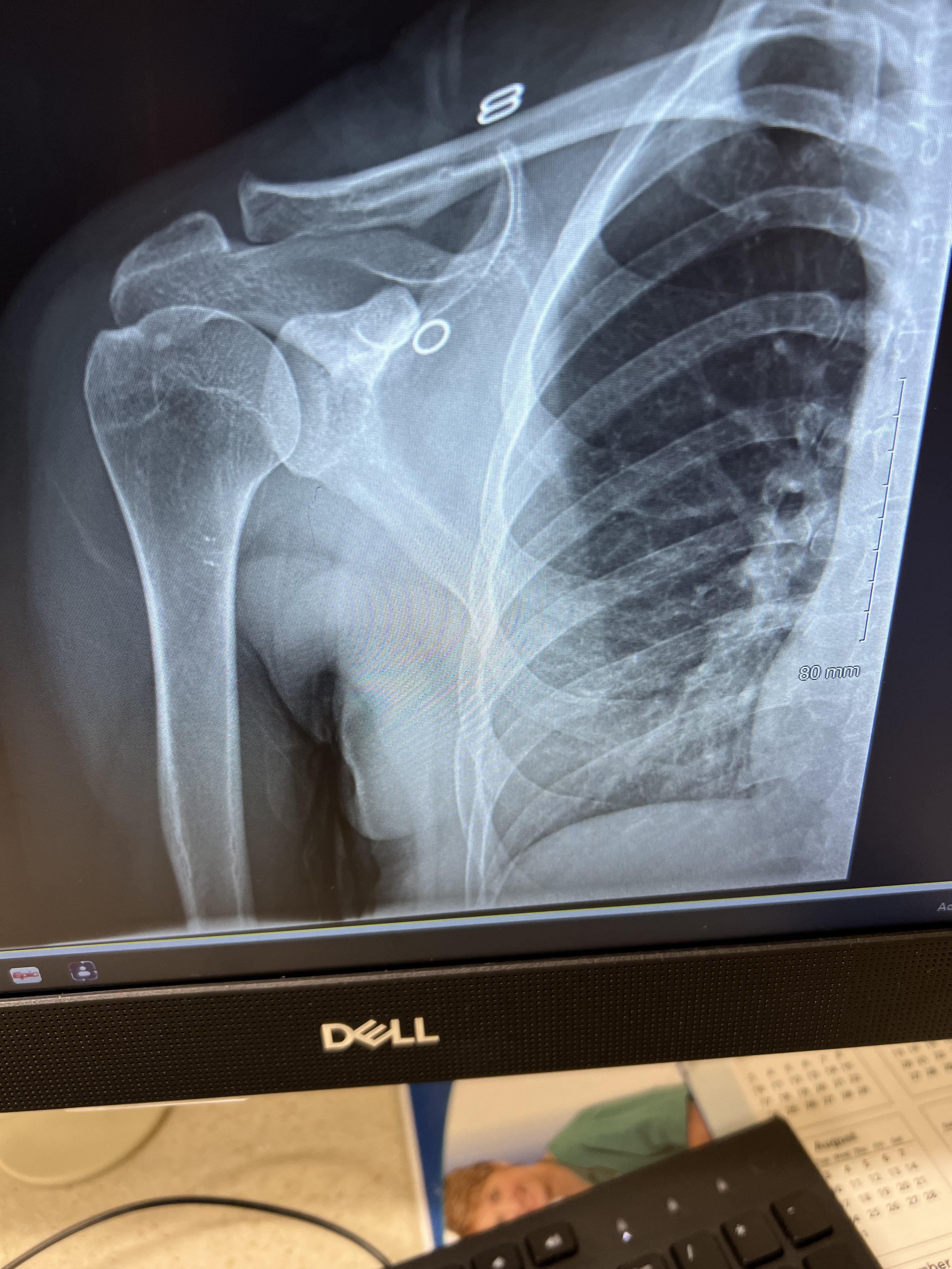 Right shoulder and clavicle pain r/Orthopedic