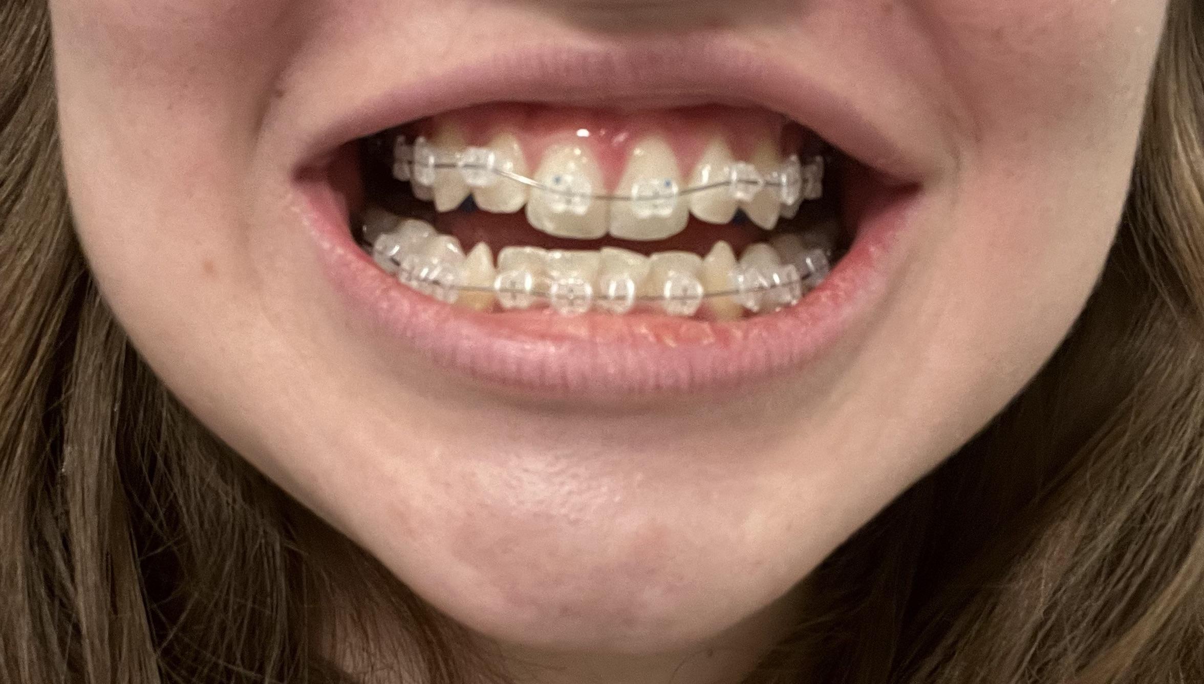 Help. I’m having excruciating pain with my braces. r/braces