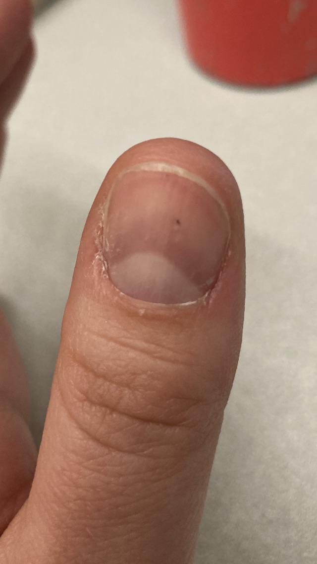 Black Dot Under Thumb Nail Is This Concerning? r/medical